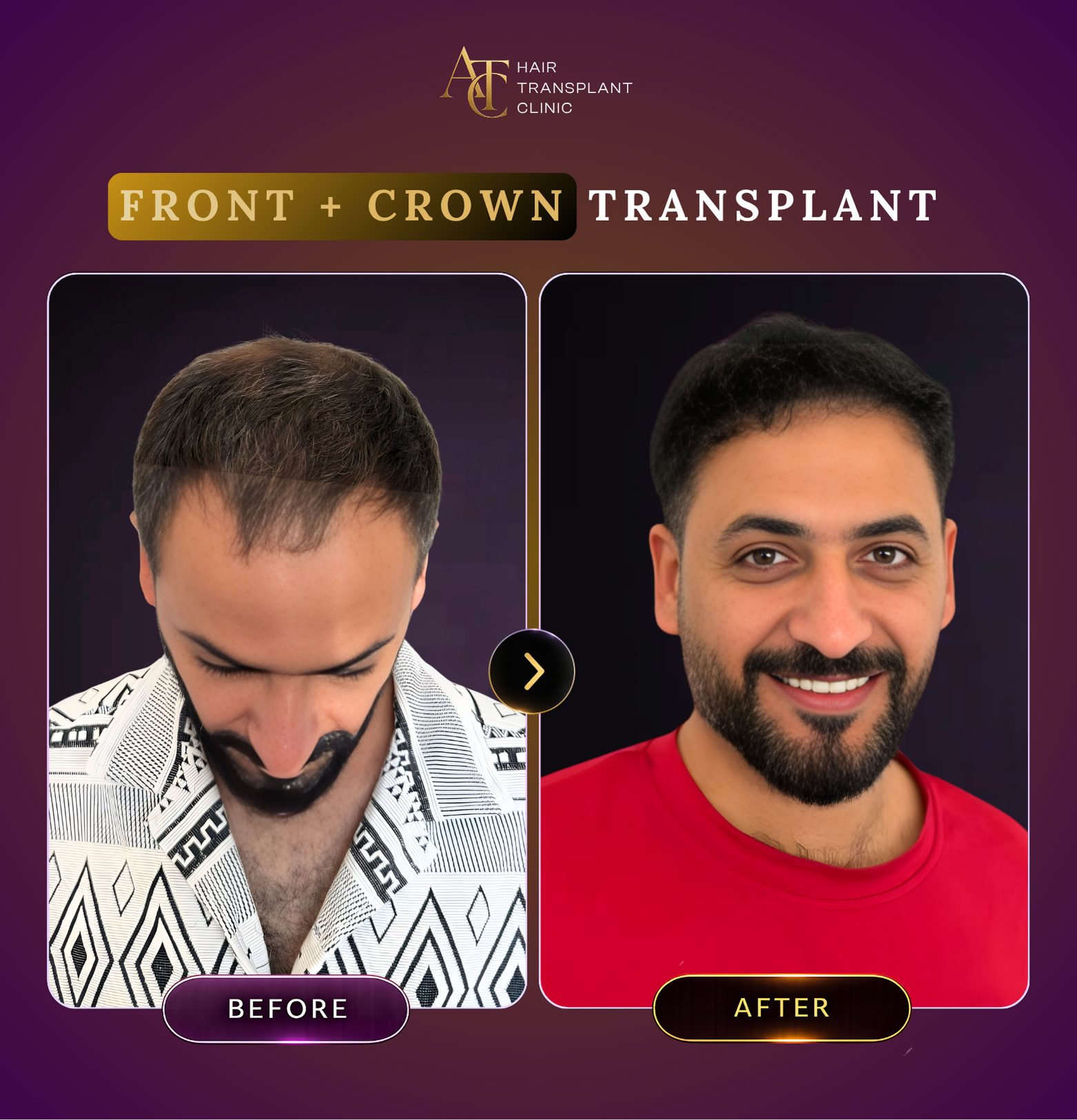 ATC Hair Transplant Result