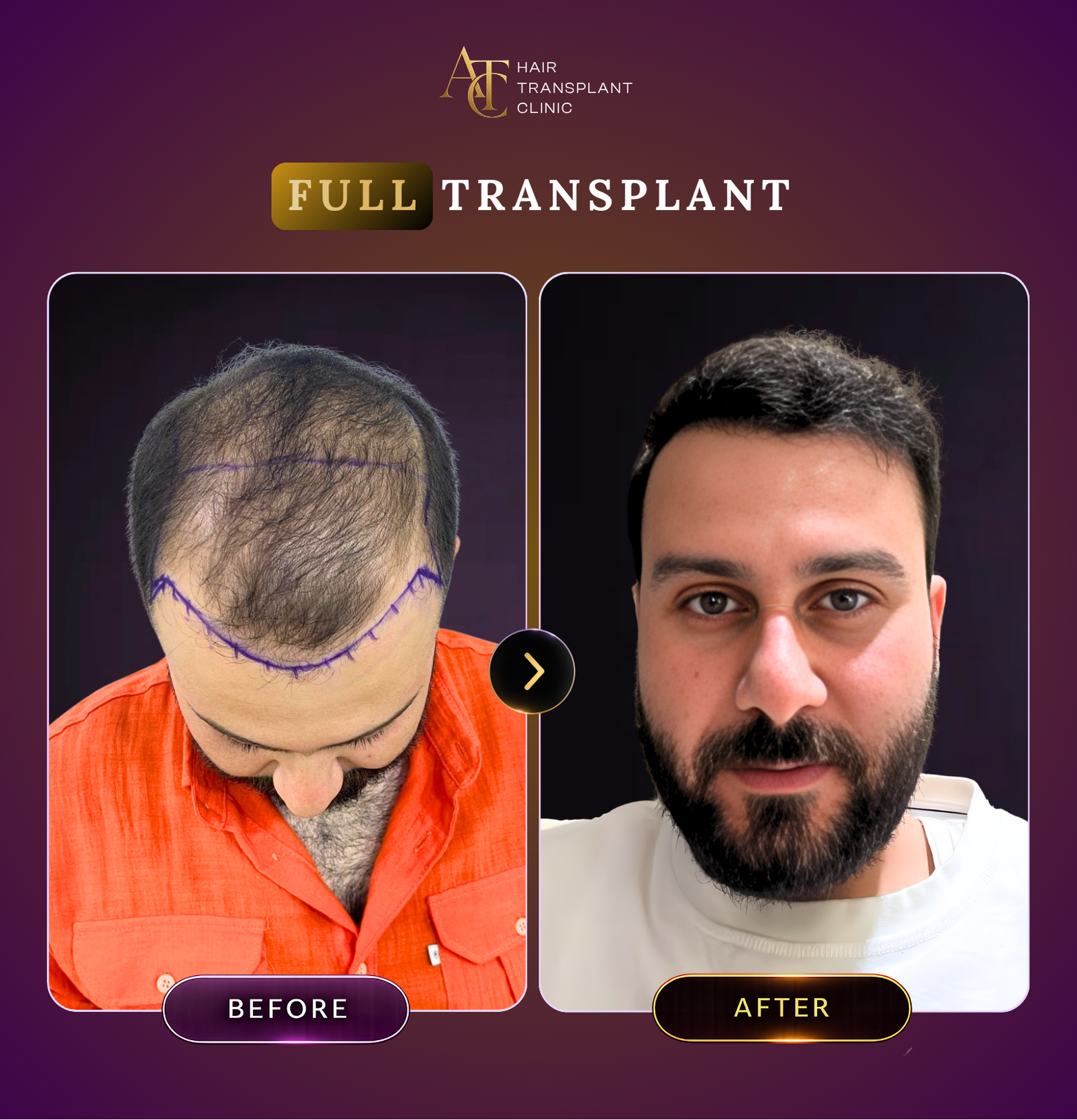 ATC Hair Transplant Result