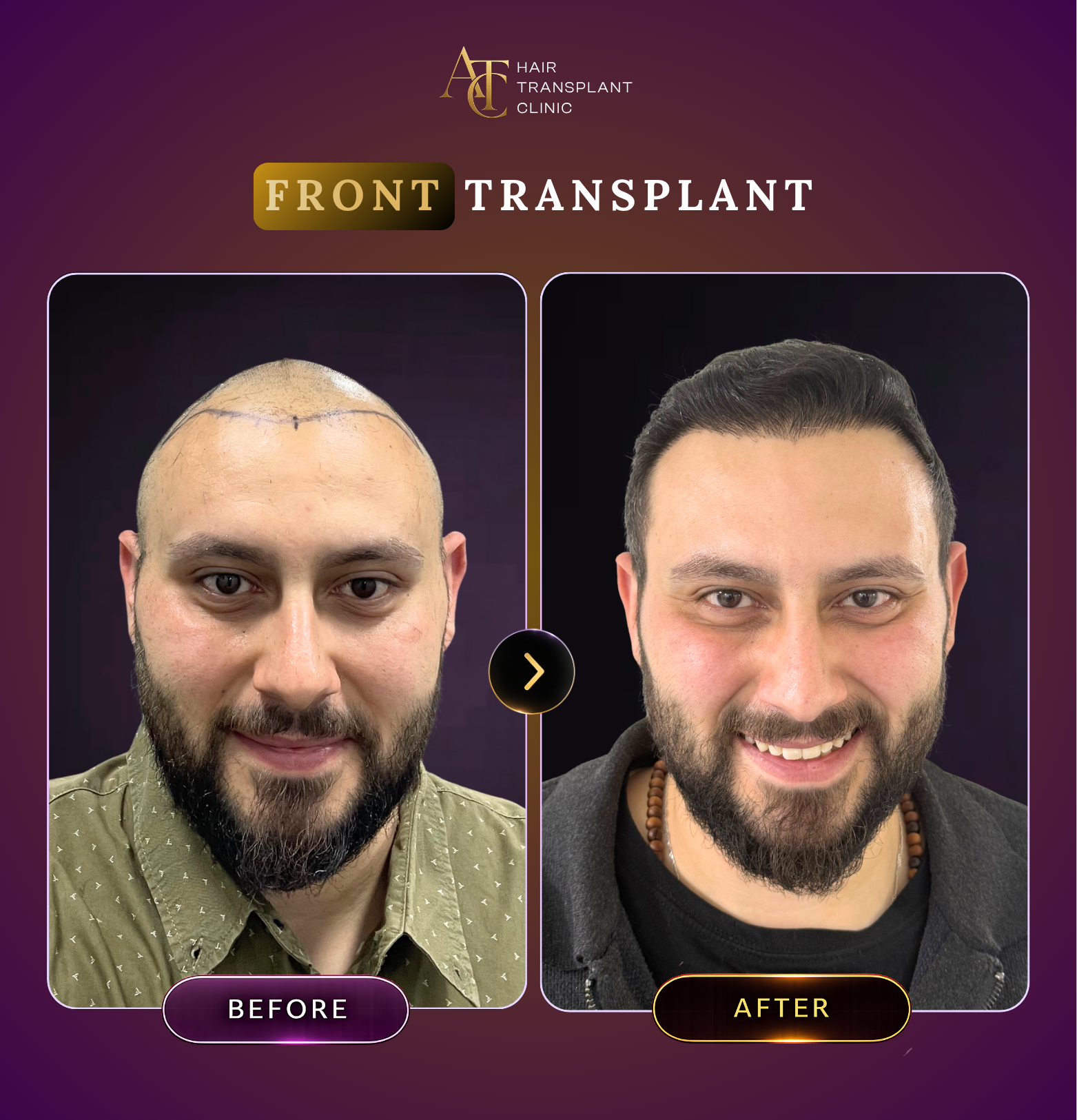 ATC Hair Transplant Result