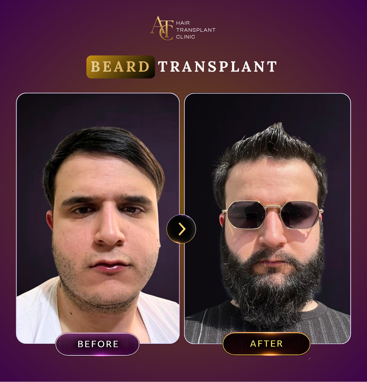 ATC Hair Transplant Result