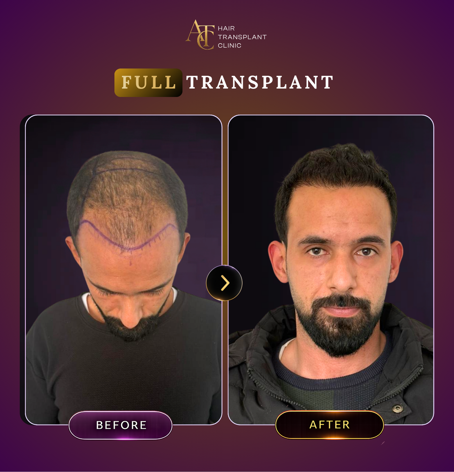 ATC Hair Transplant Result