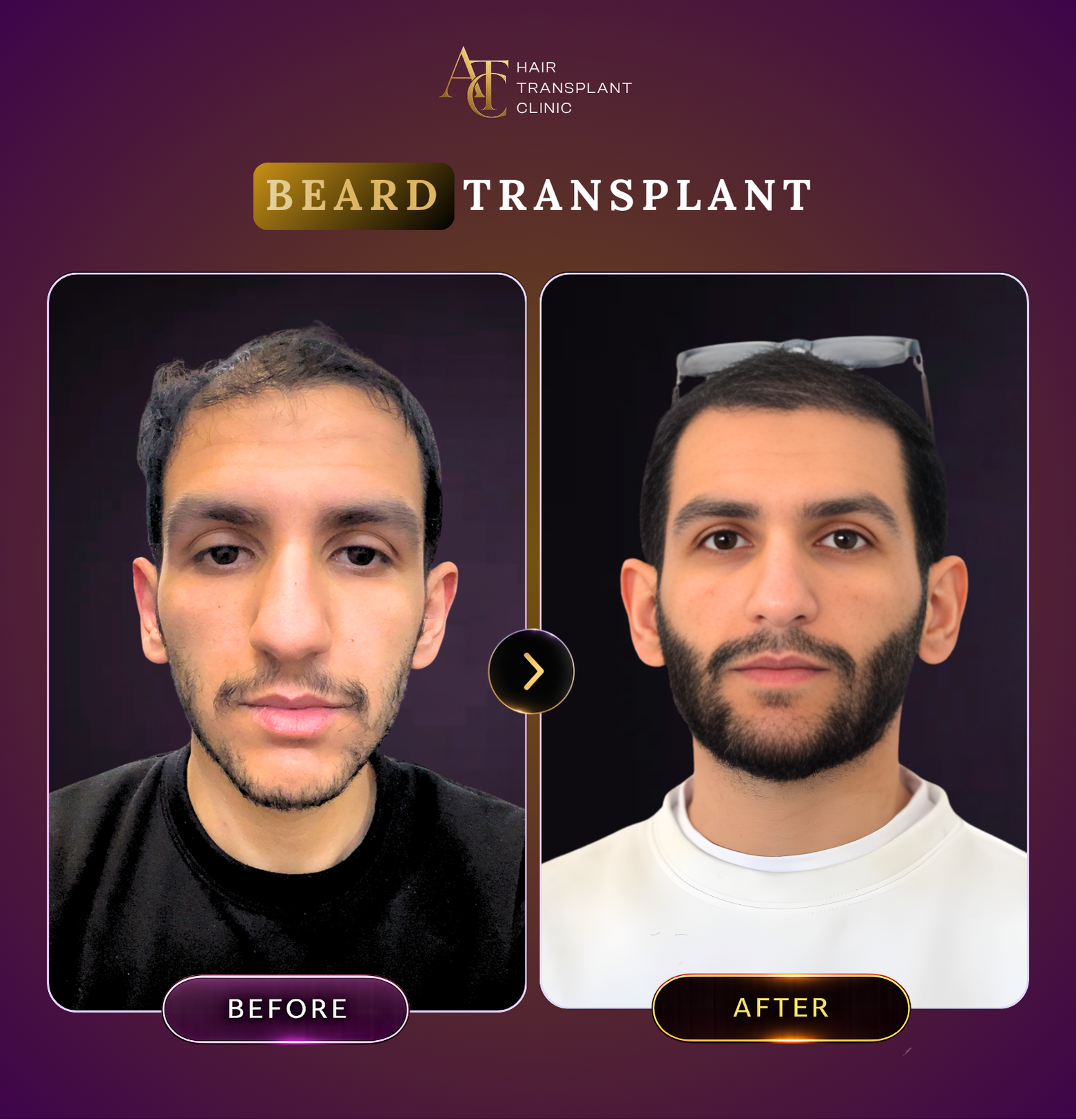 ATC Hair Transplant Result