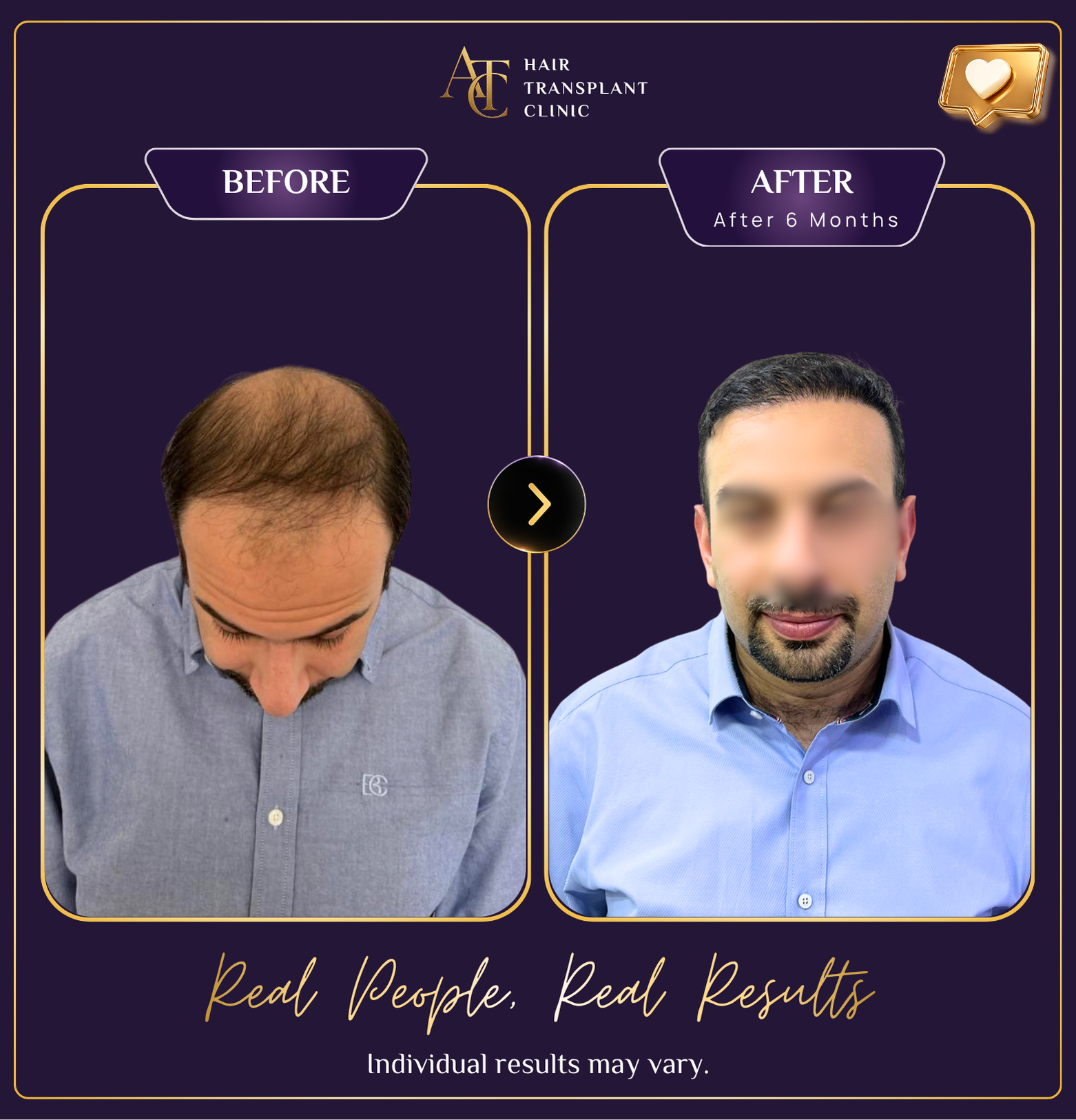 Hair transplant before and after result 1