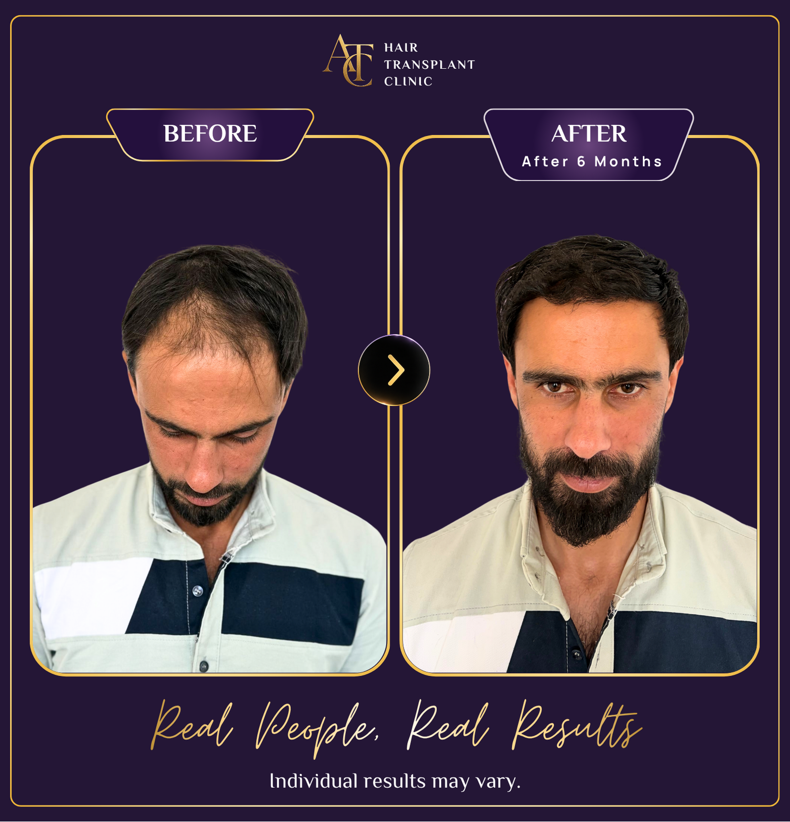 Hair transplant before and after result 2