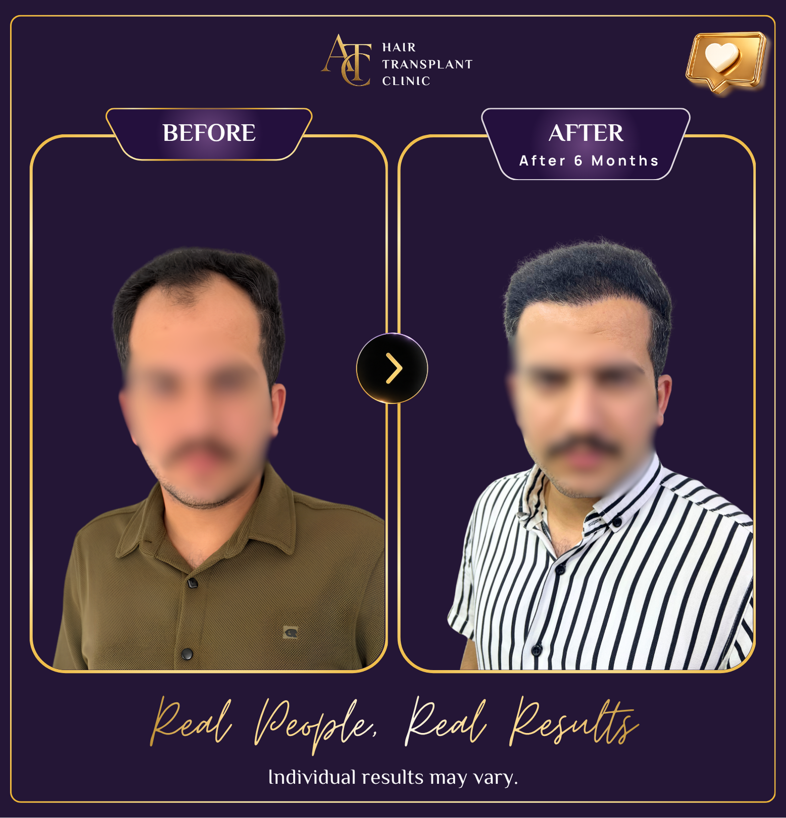 Hair transplant before and after result 3