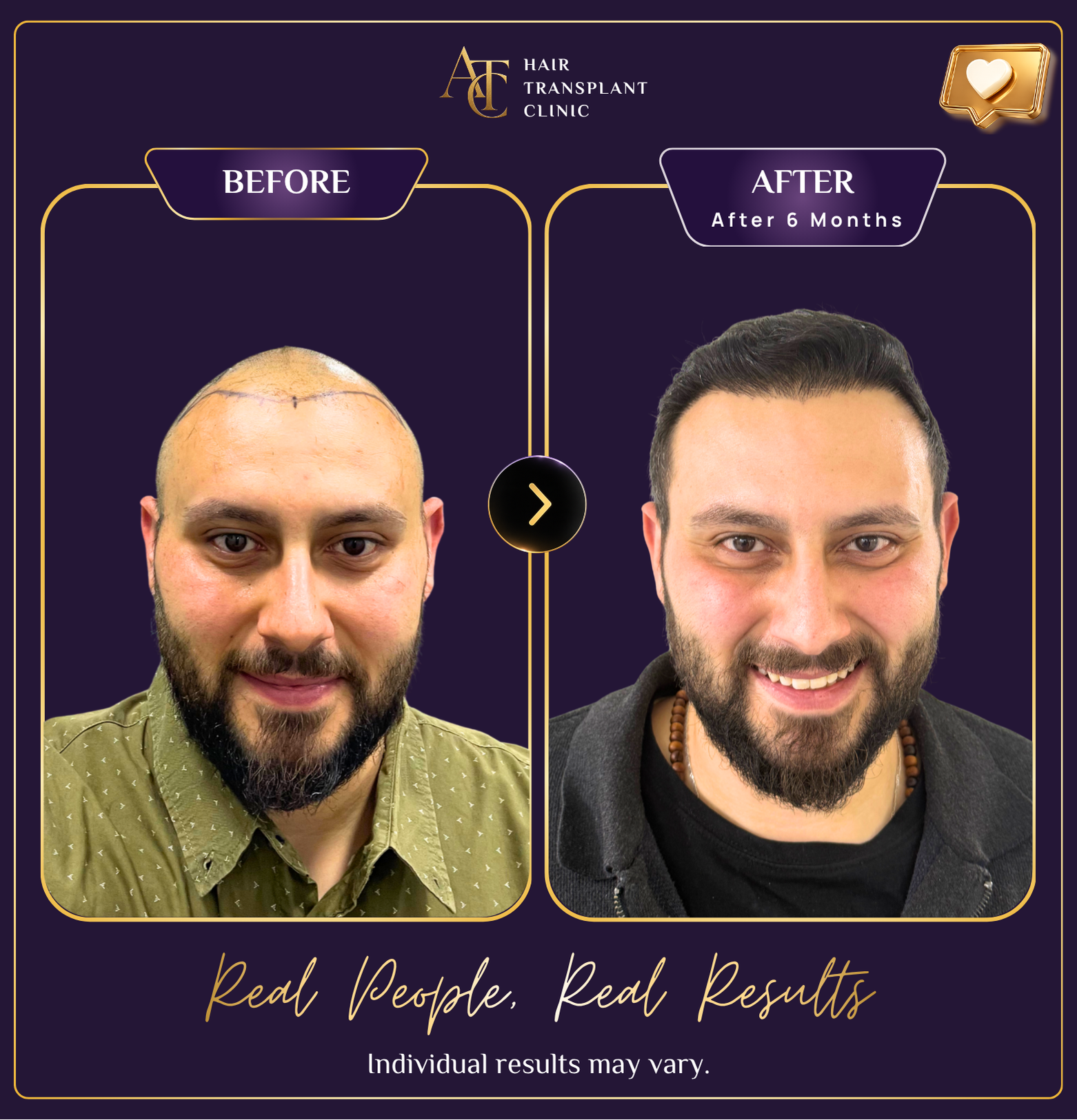 Hair transplant before and after result 4