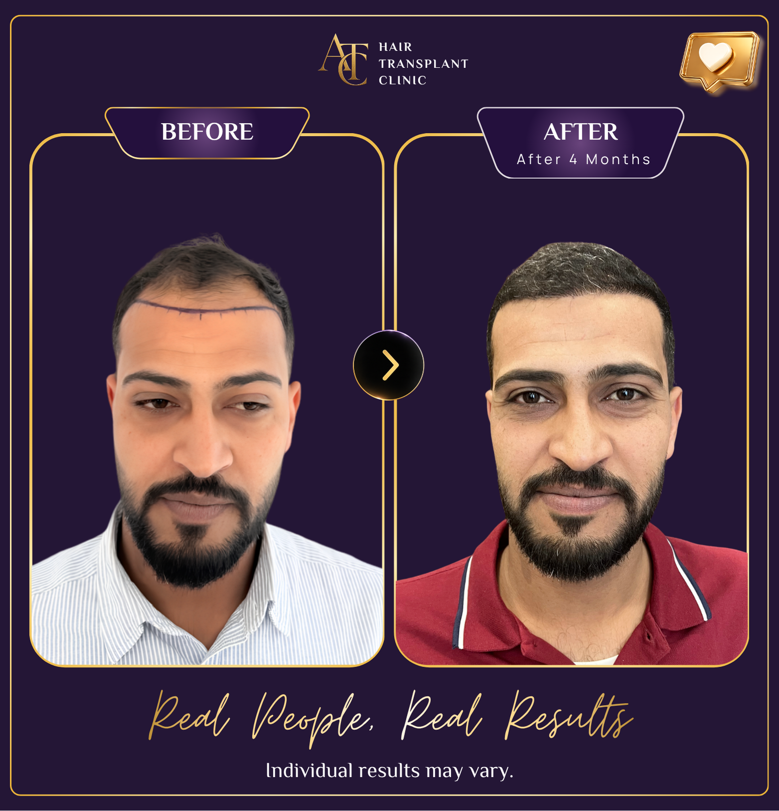 Hair transplant before and after result 5