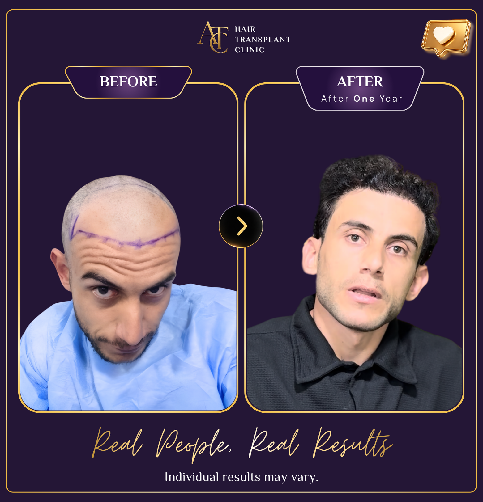 Hair transplant before and after result 6