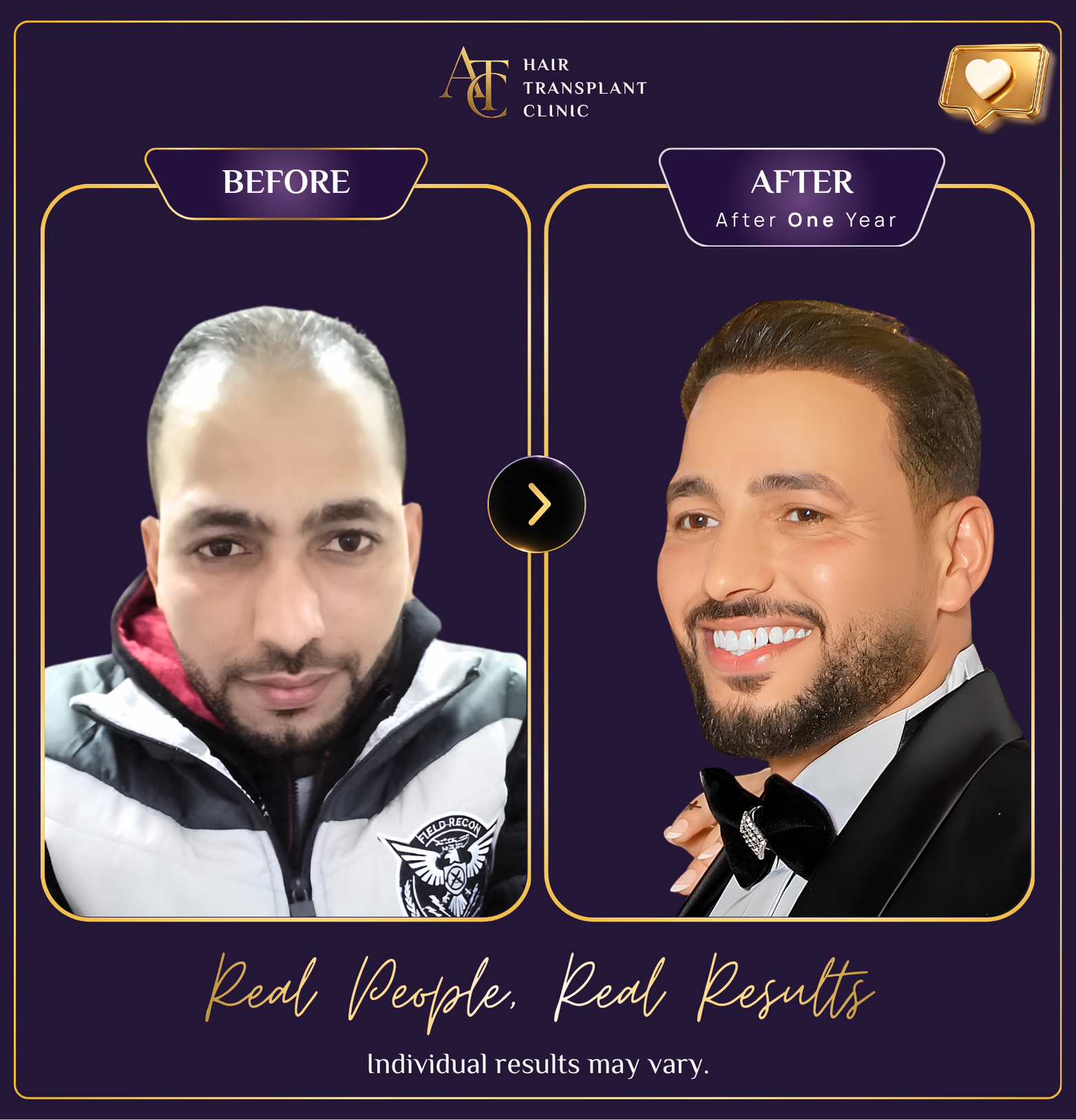 Hair transplant before and after result 7
