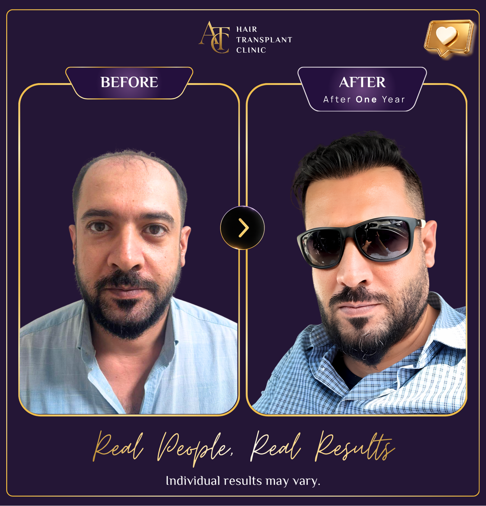 Hair transplant before and after result 8