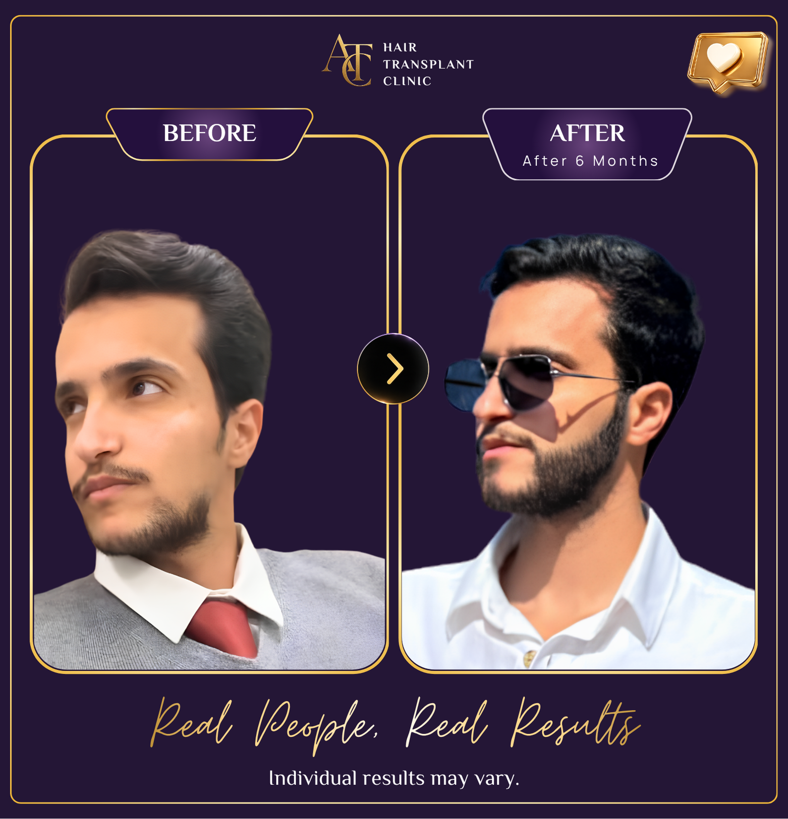 Hair transplant before and after result 9