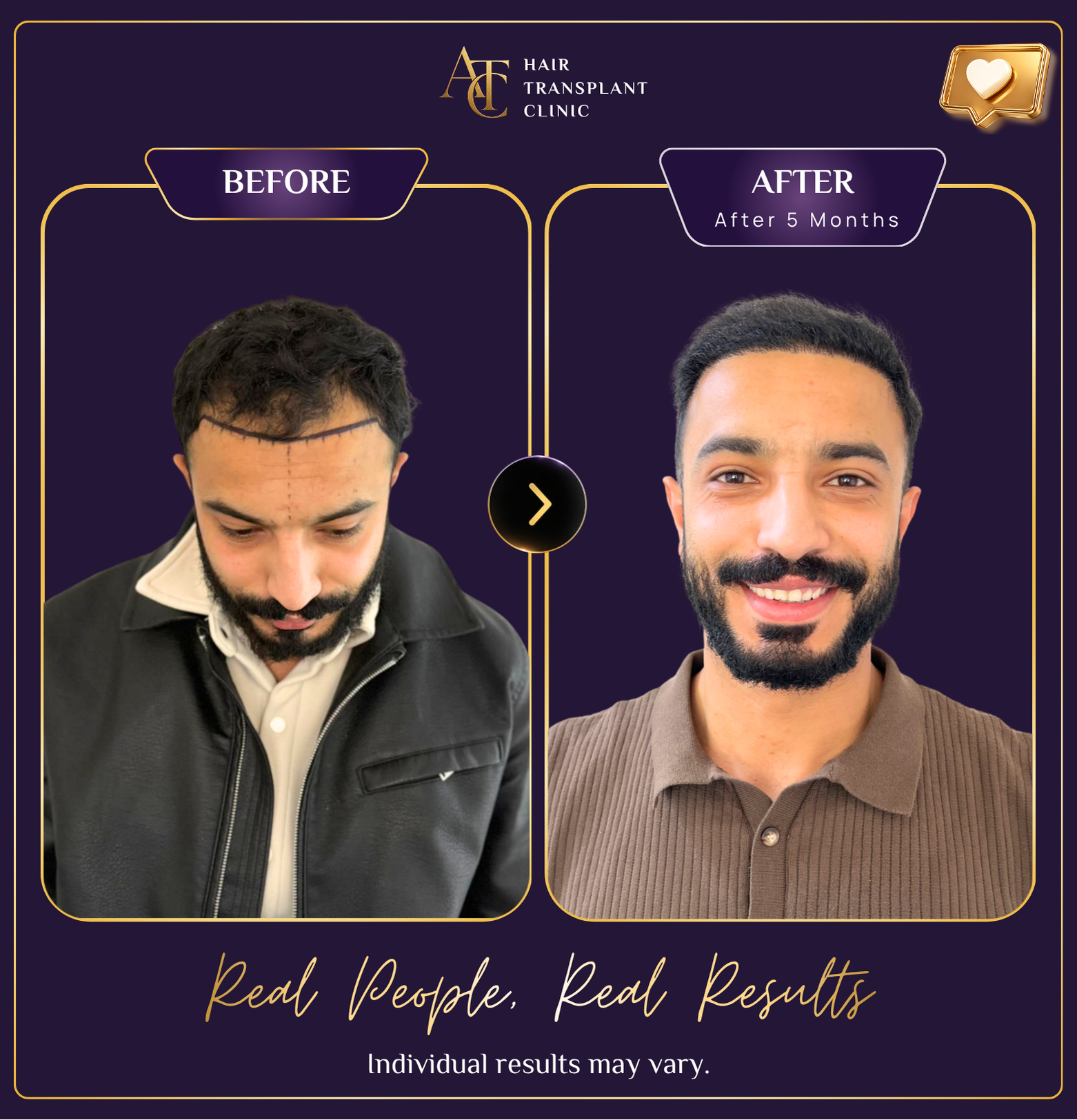 Hair transplant before and after result 10