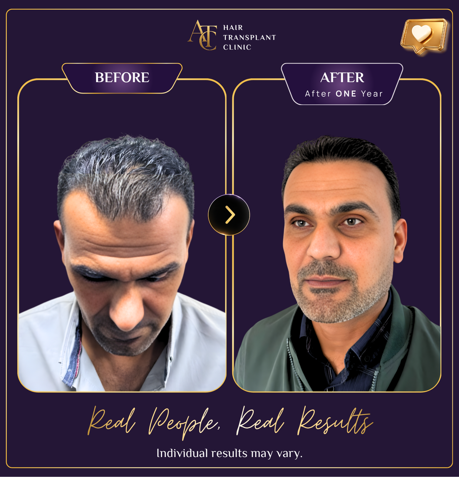 Hair transplant before and after result 11