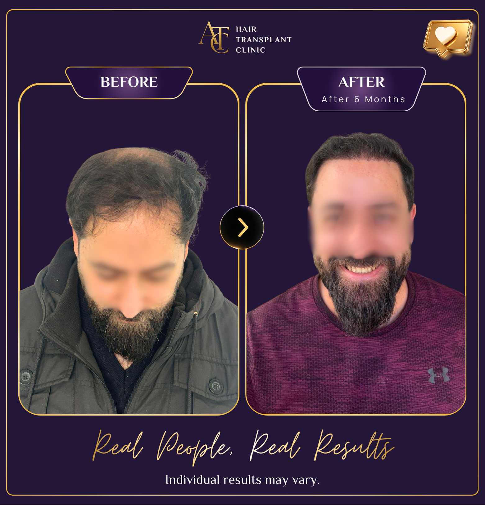 Hair transplant before and after result 12