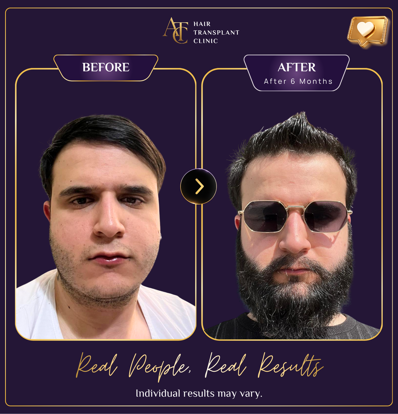 Hair transplant before and after result 13