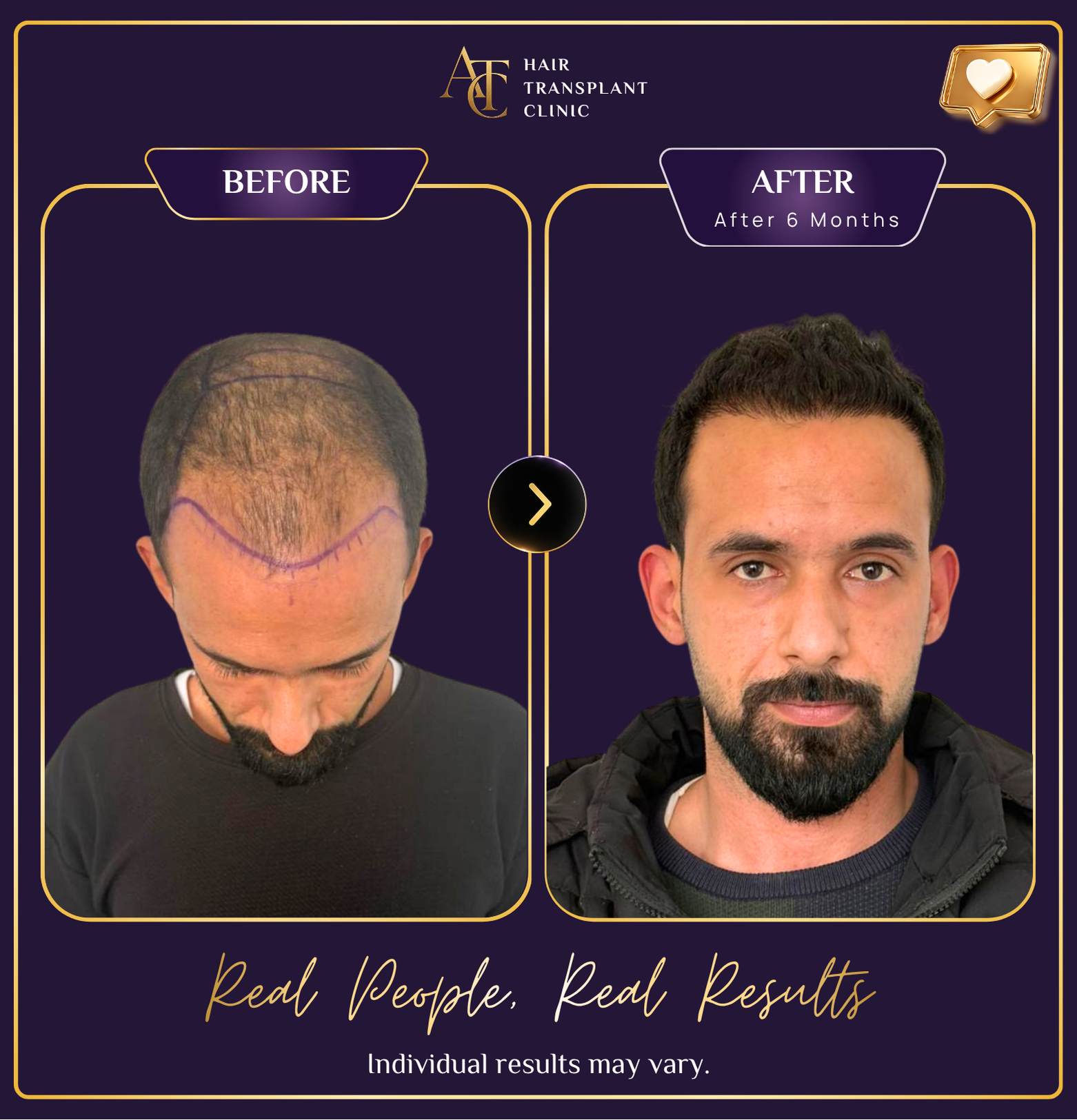 Hair transplant before and after result 14