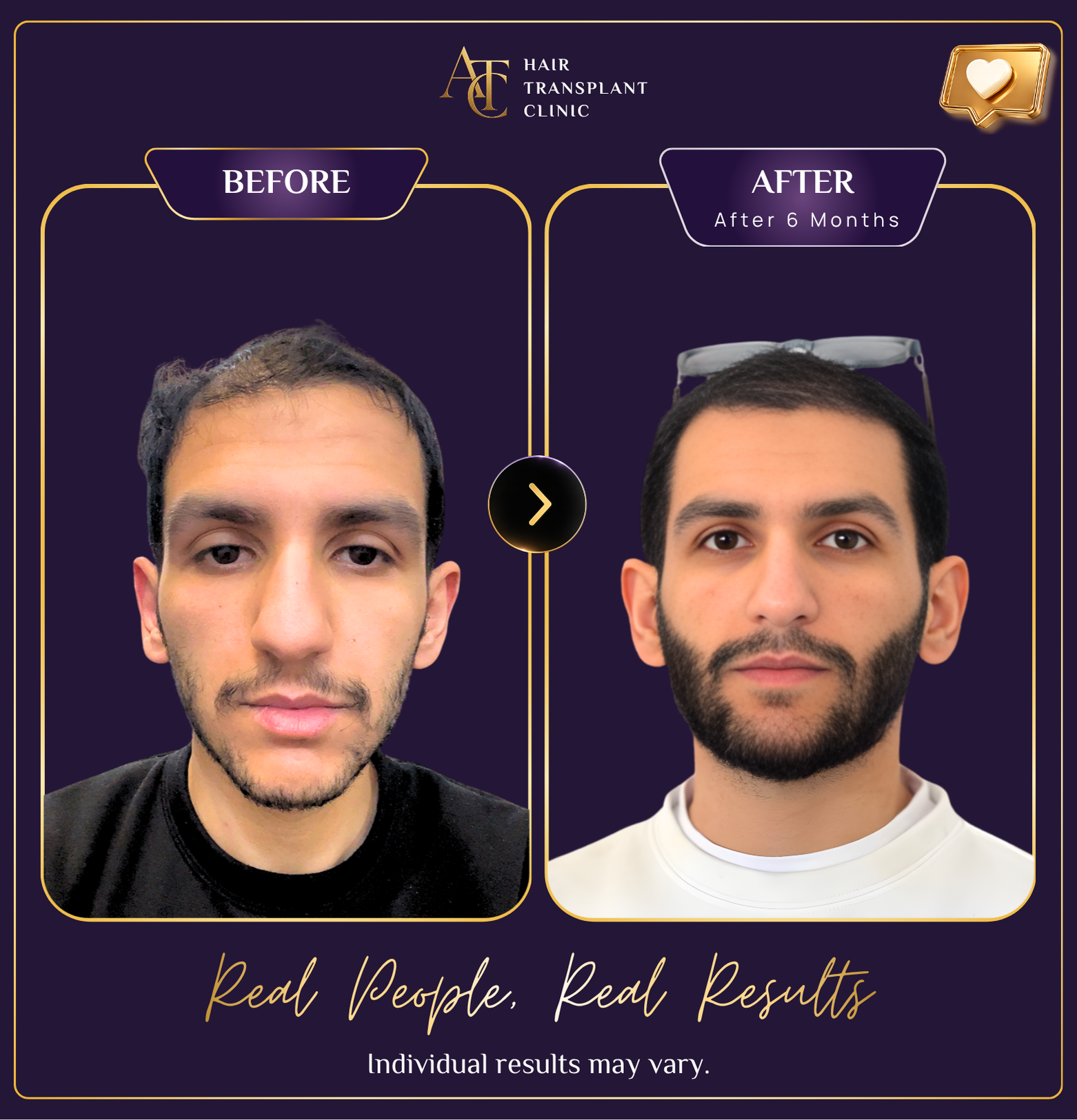 Hair transplant before and after result 15