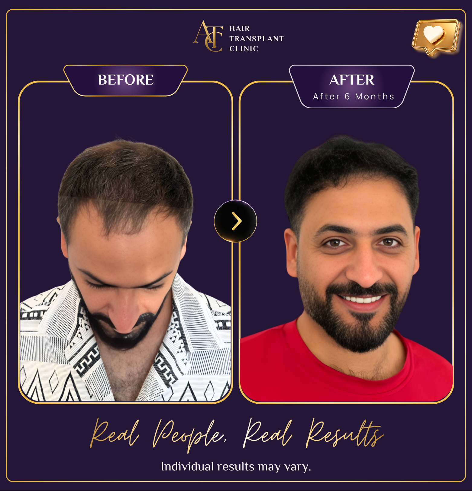 Hair transplant before and after result 16