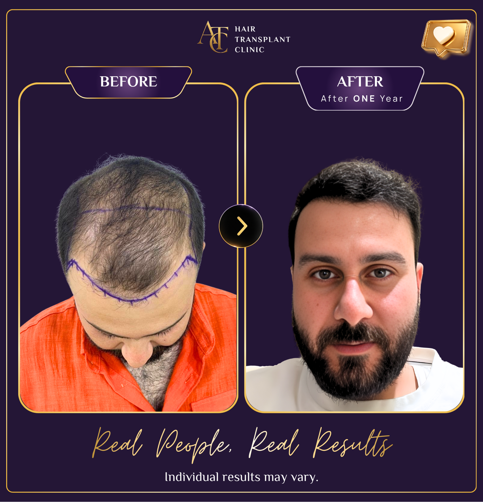 Hair transplant before and after result 17