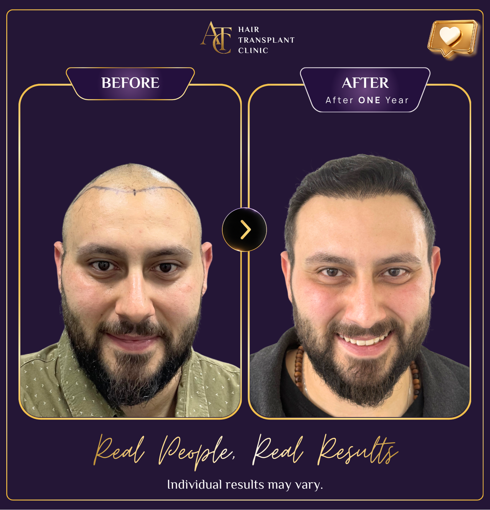 Hair transplant before and after result 18