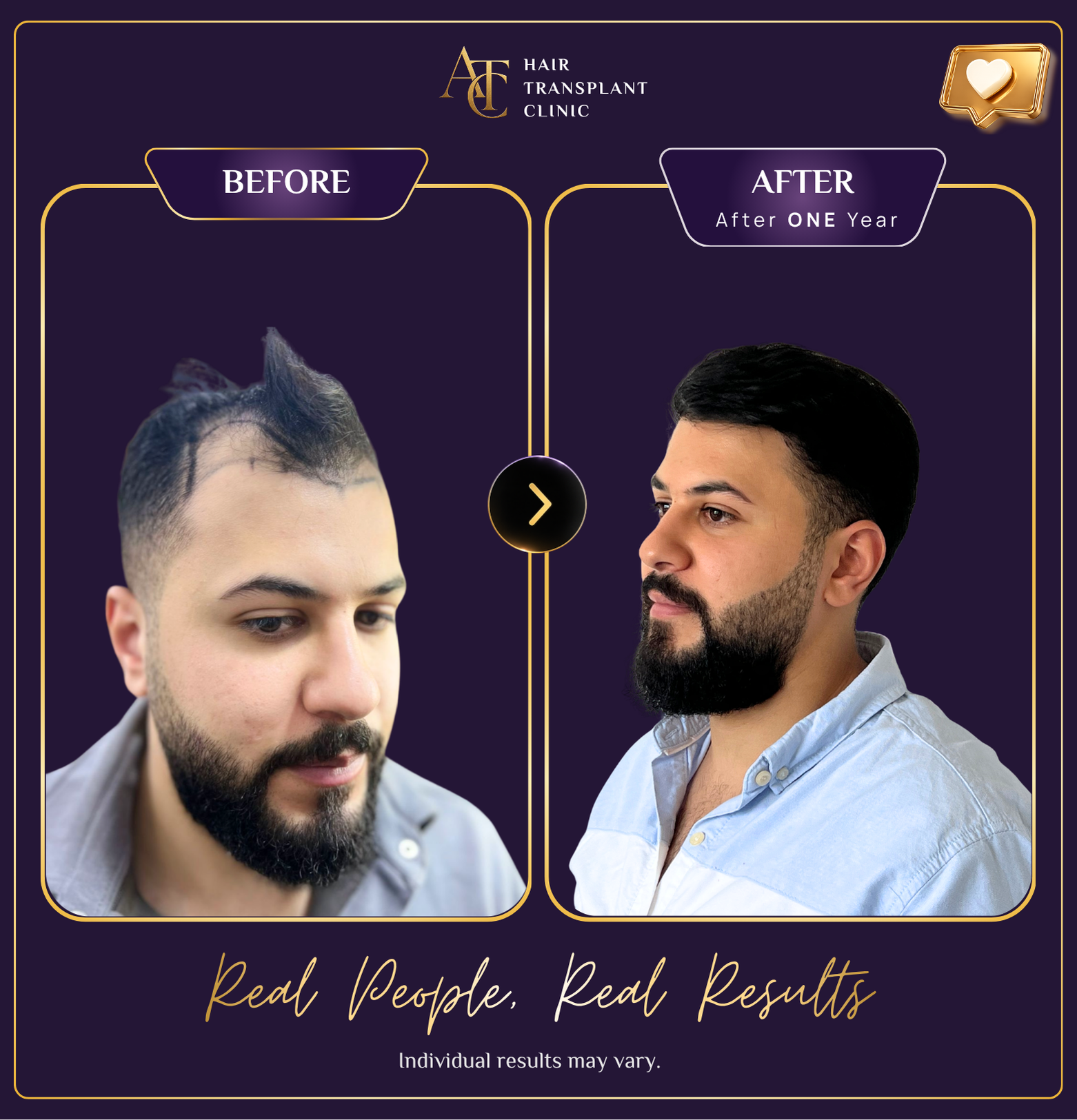 Hair transplant before and after result 19