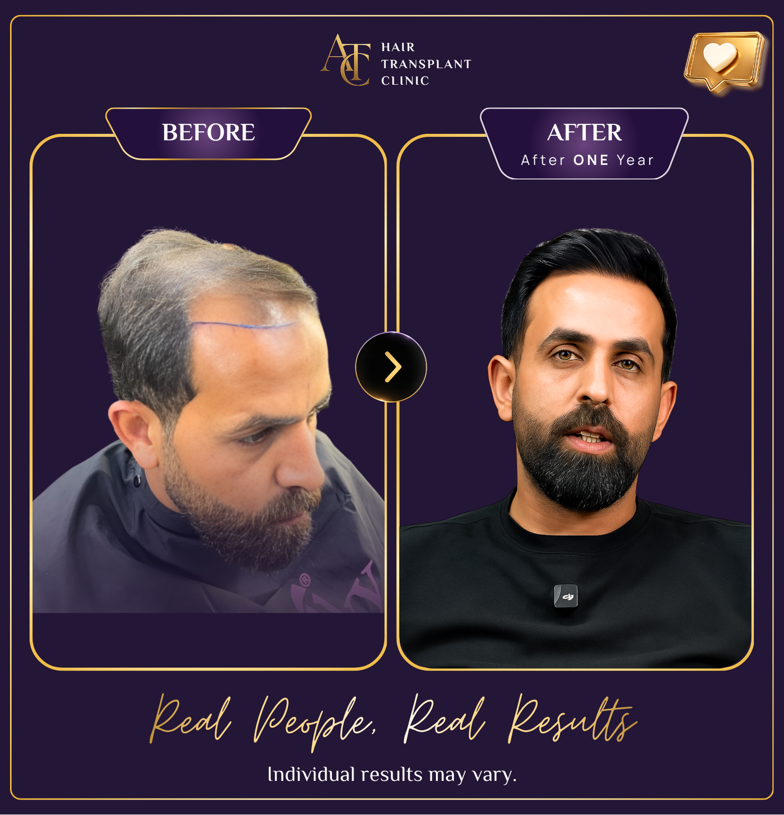 Hair transplant before and after result 20