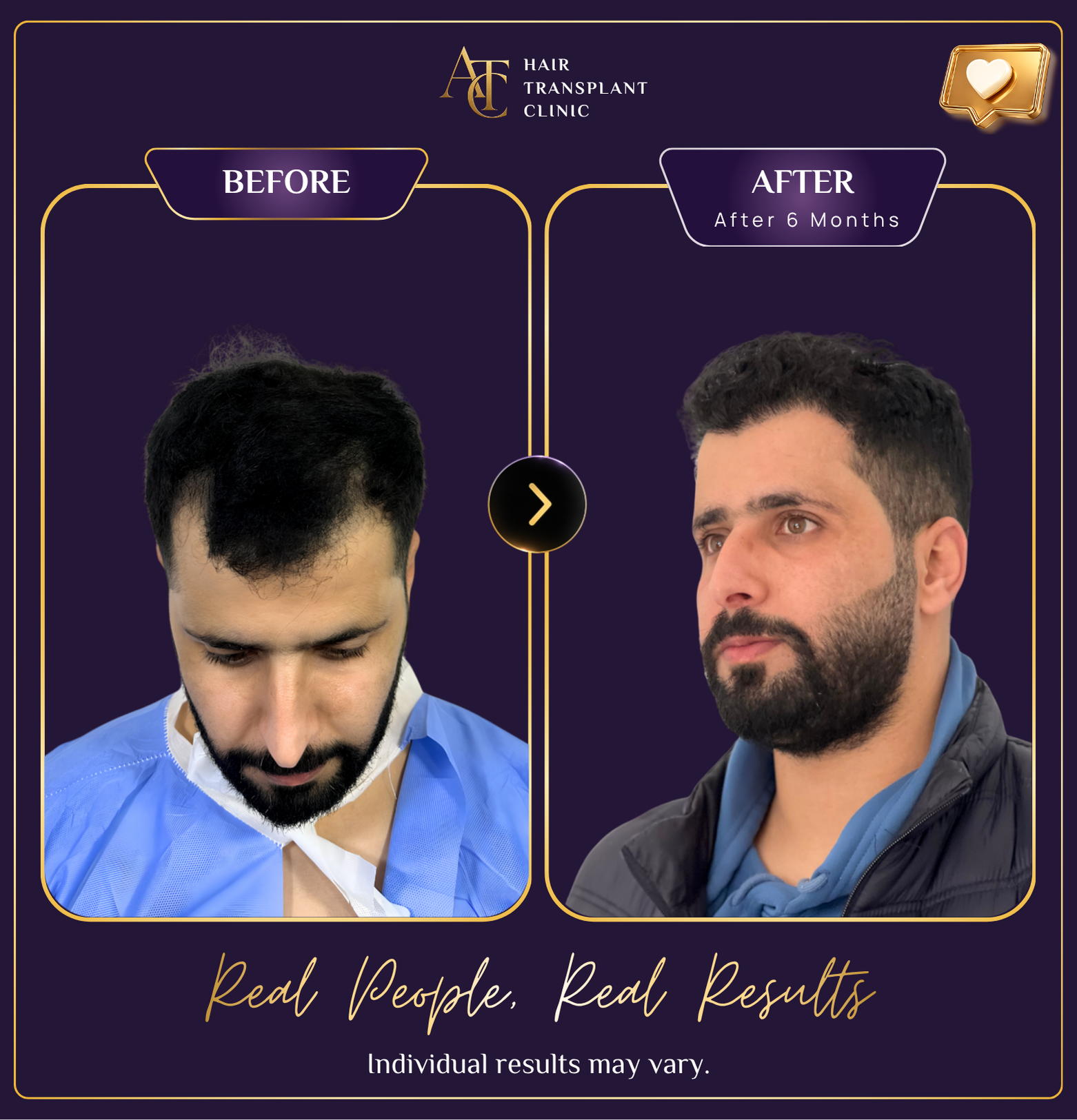 Hair transplant before and after result 21