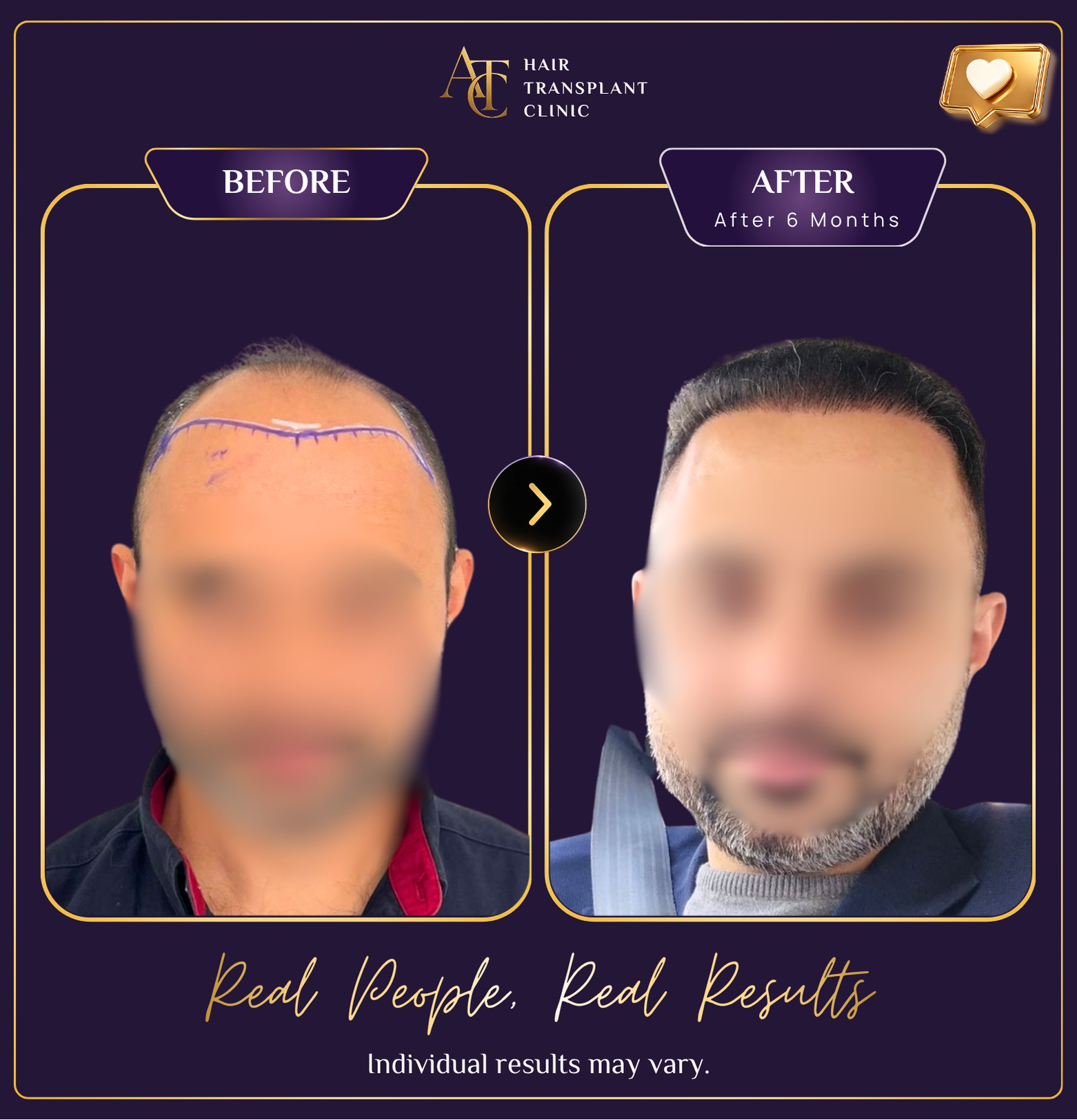 Hair transplant before and after result 22
