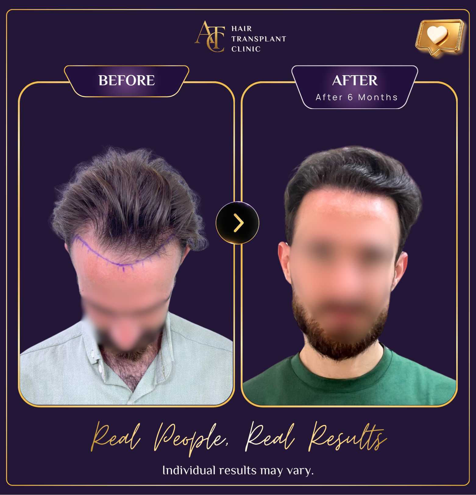 Hair transplant before and after result 23