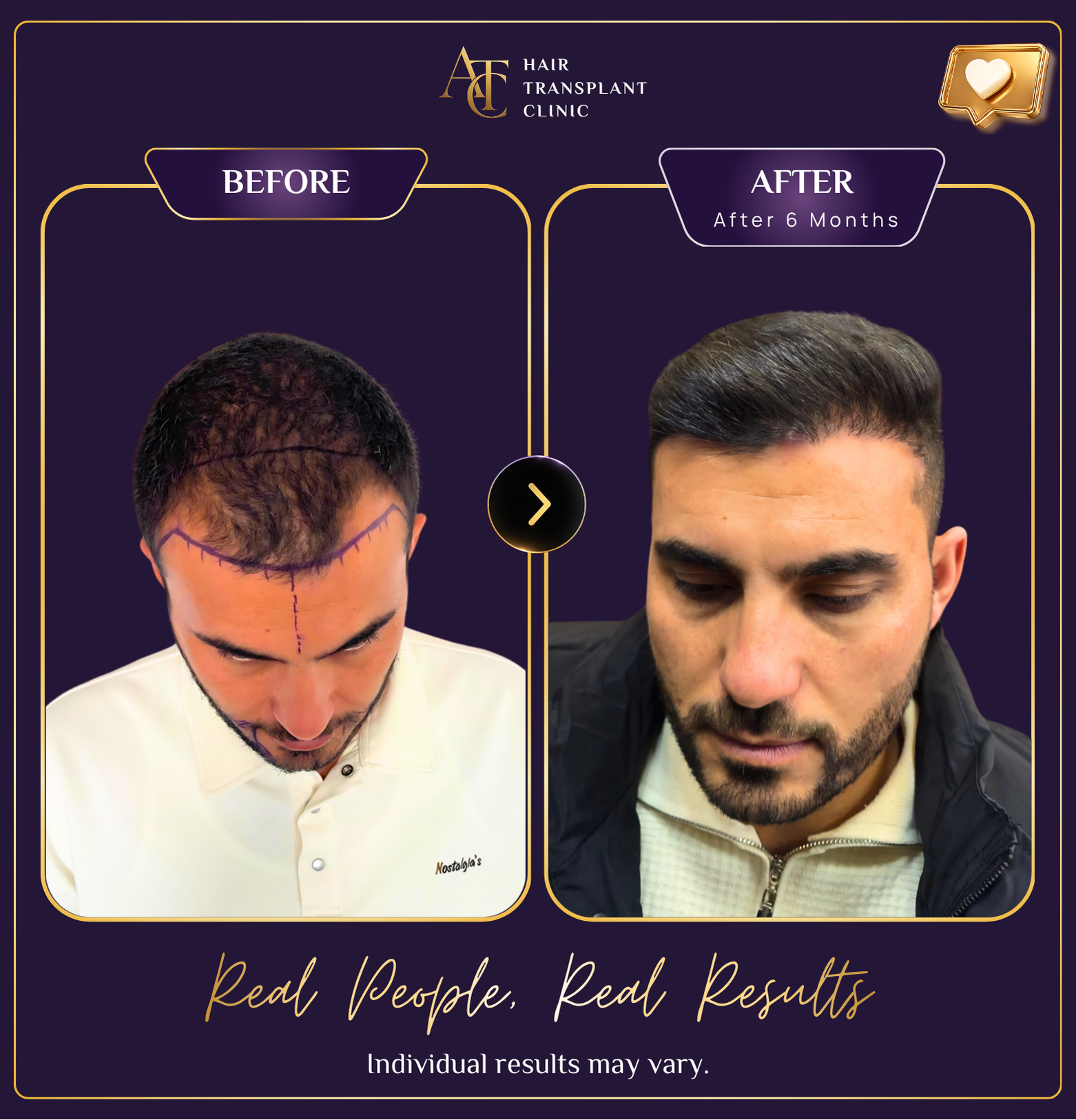 Hair transplant before and after result 24