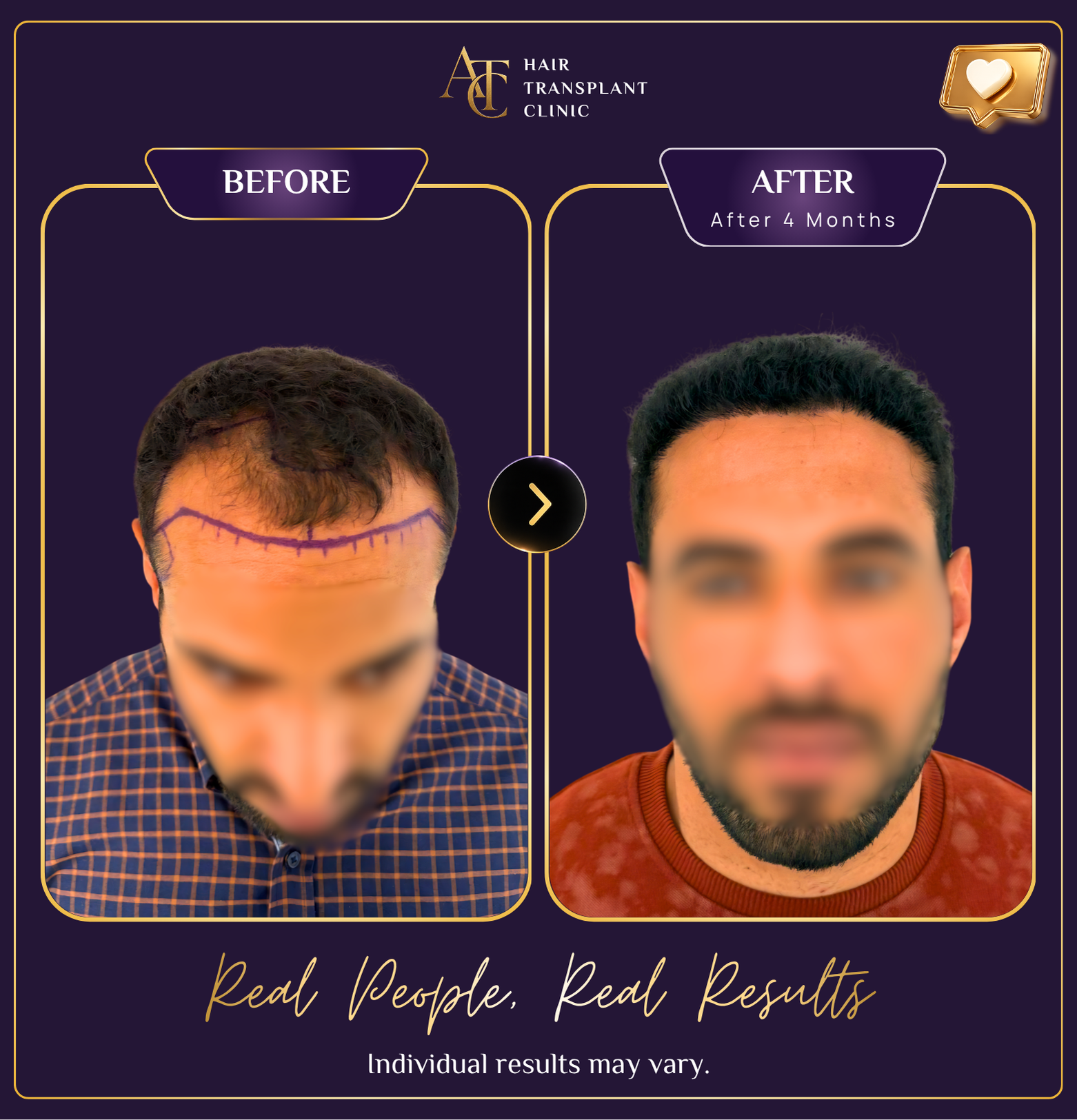 Hair transplant before and after result 25