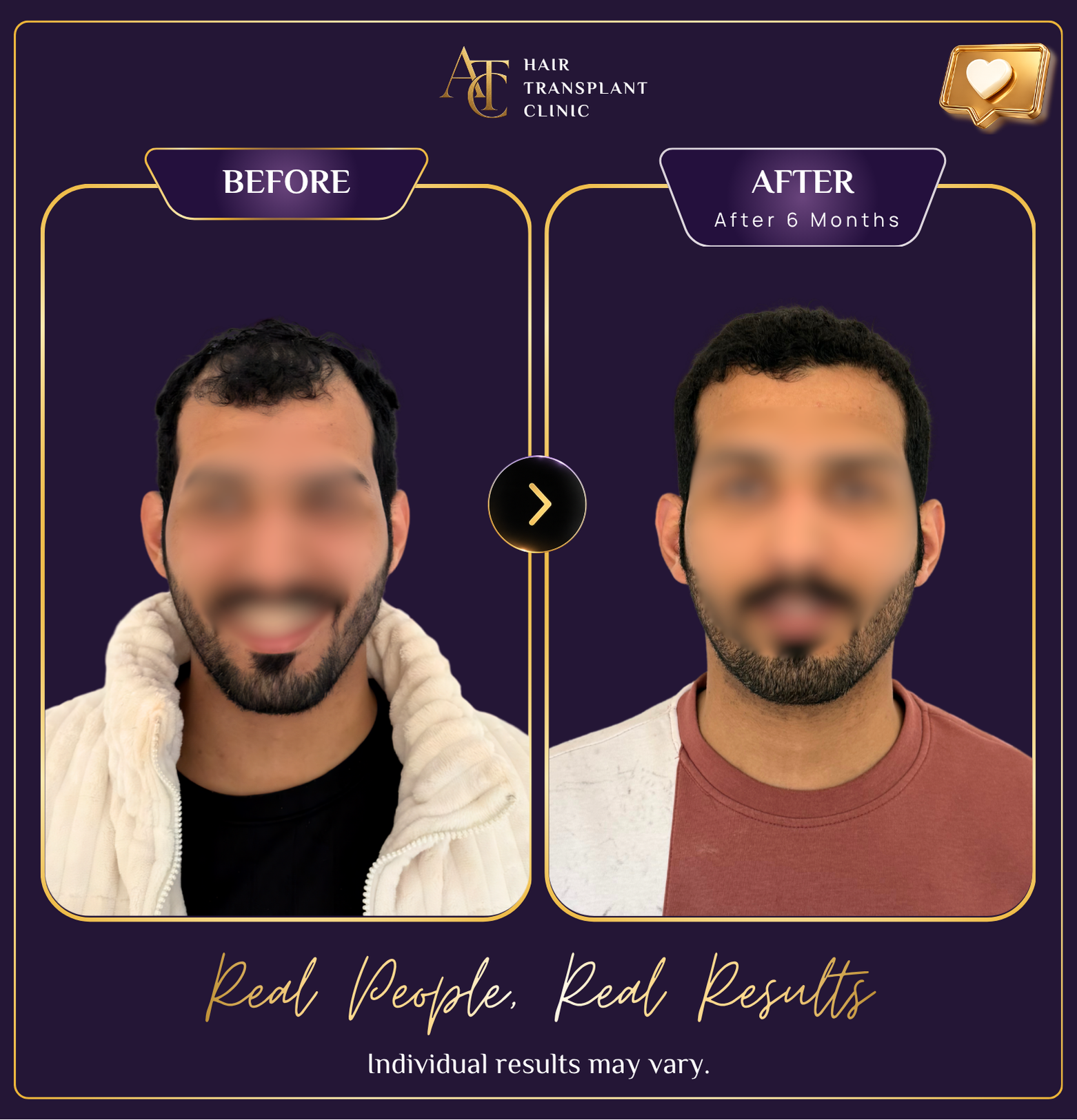 Hair transplant before and after result 26