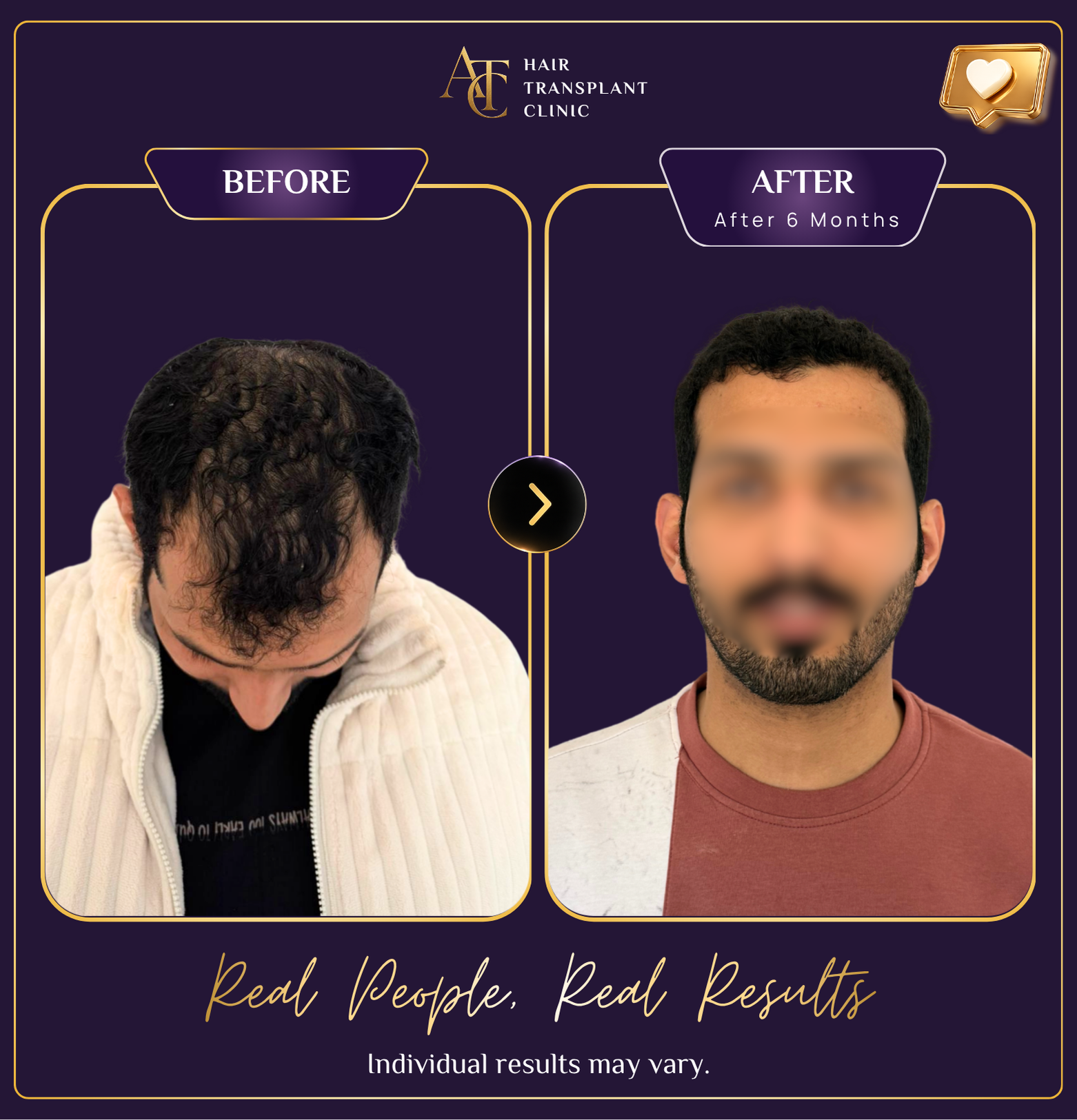 Hair transplant before and after result 27