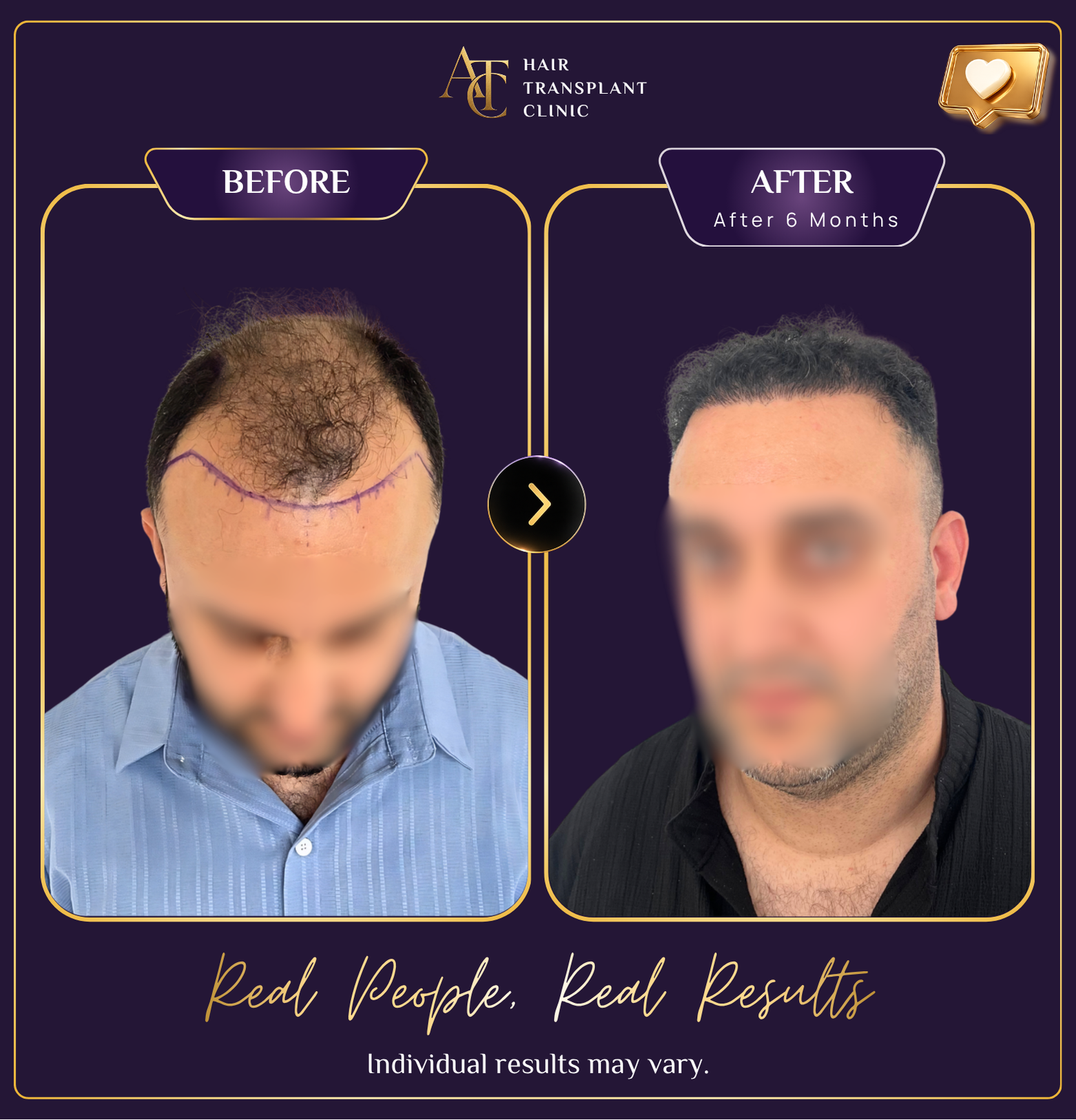 Hair transplant before and after result 28