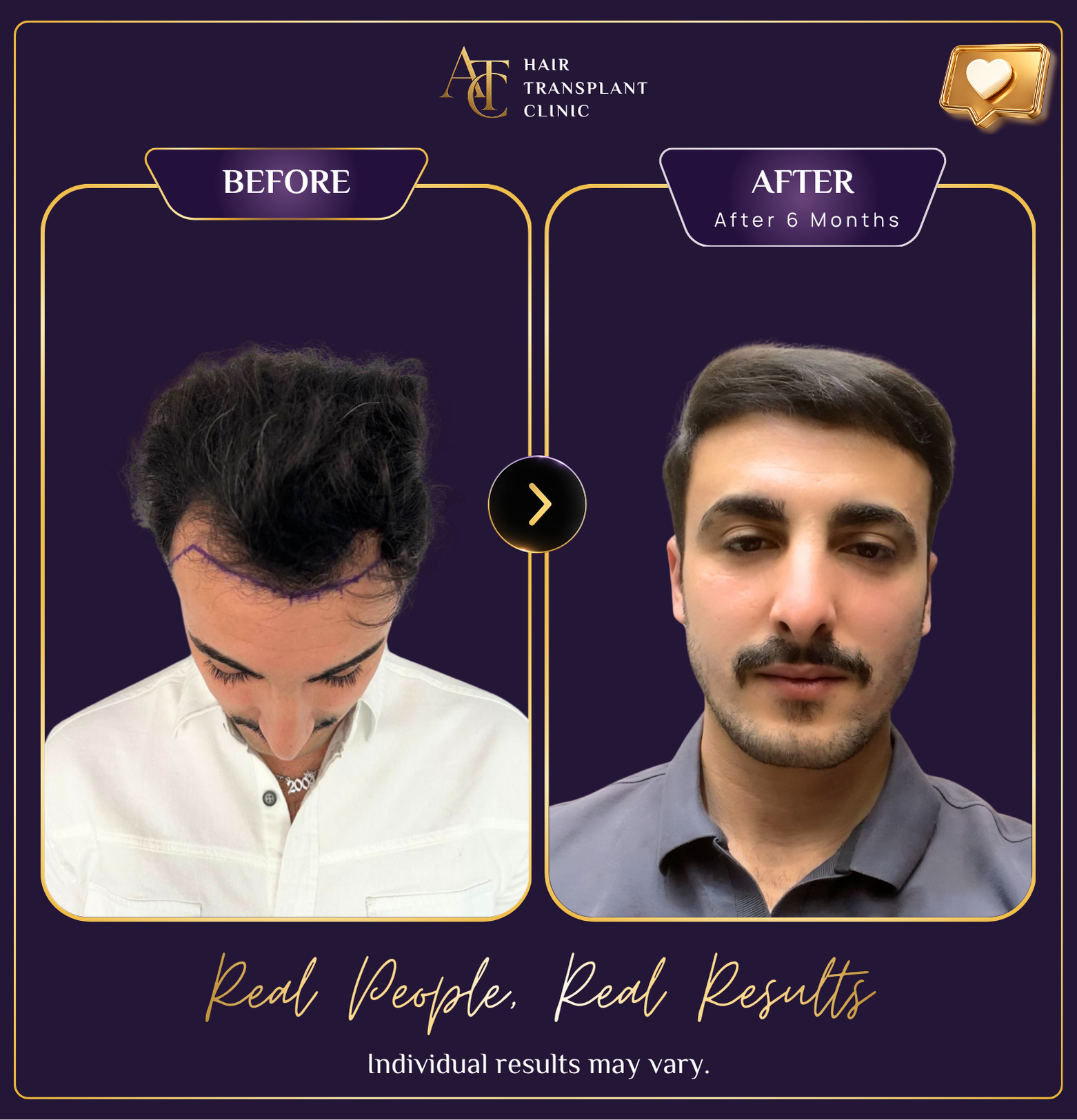 Hair transplant before and after result 29
