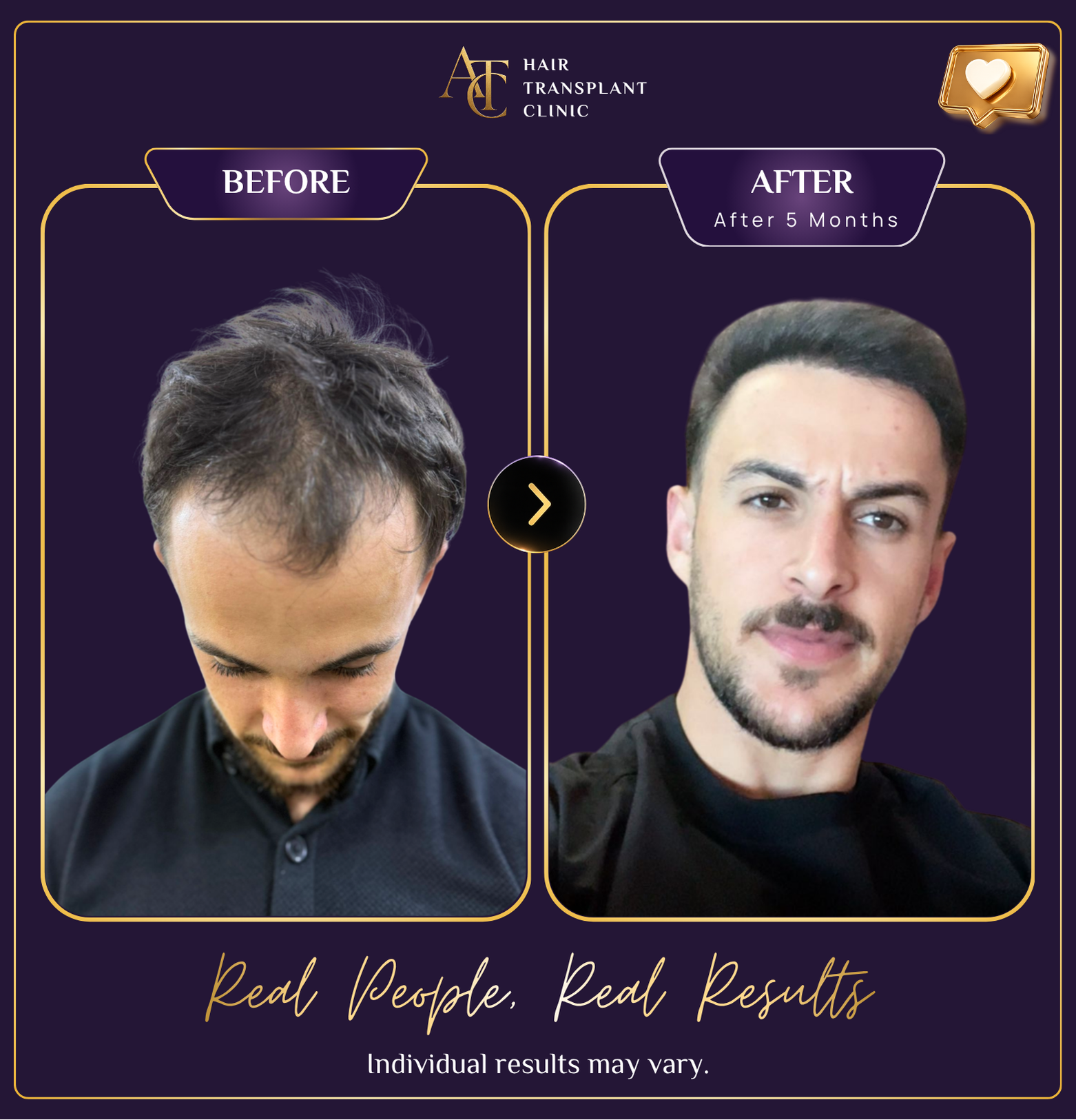 Hair transplant before and after result 30