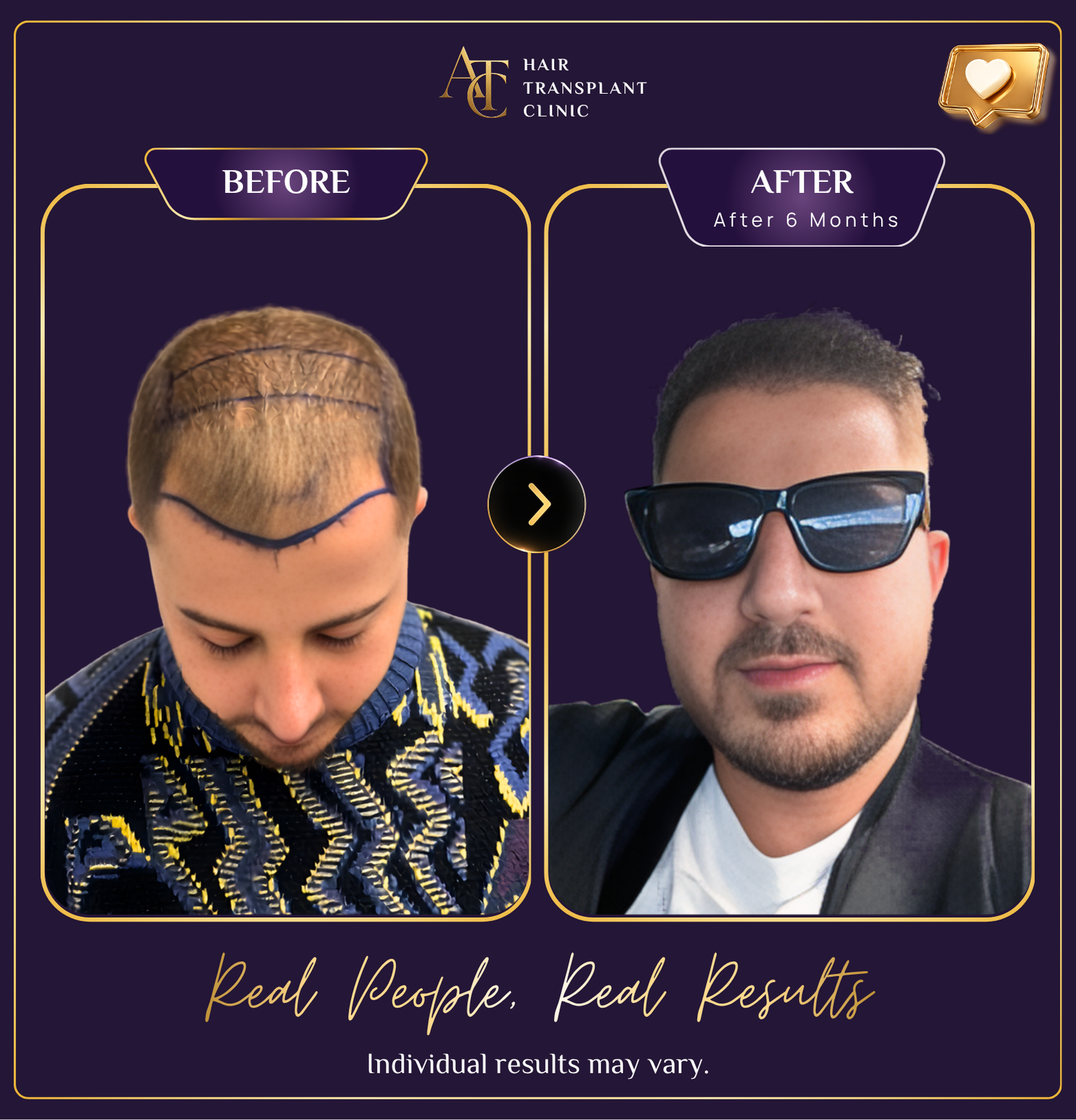 Hair transplant before and after result 31
