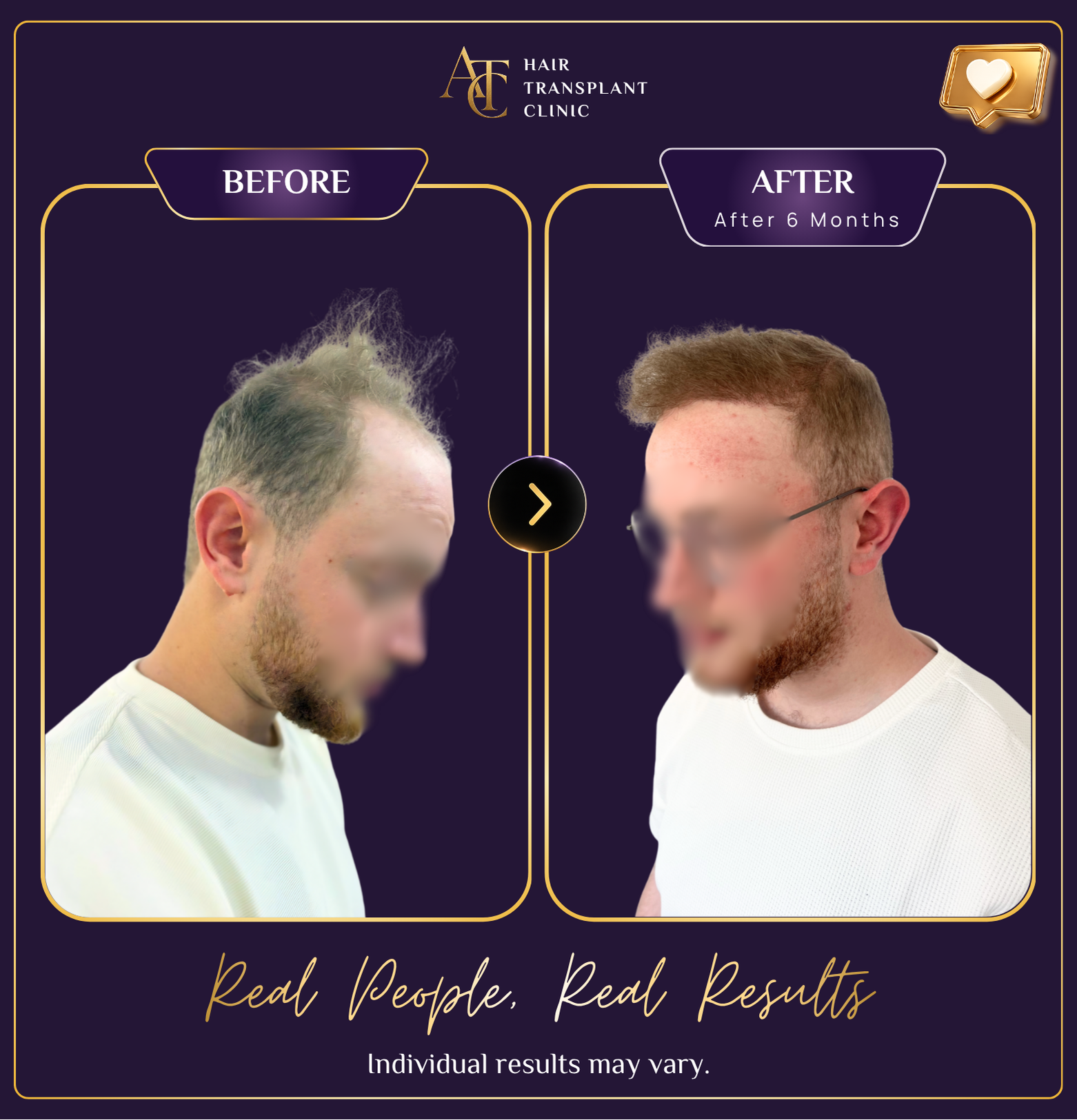 Hair transplant before and after result 32