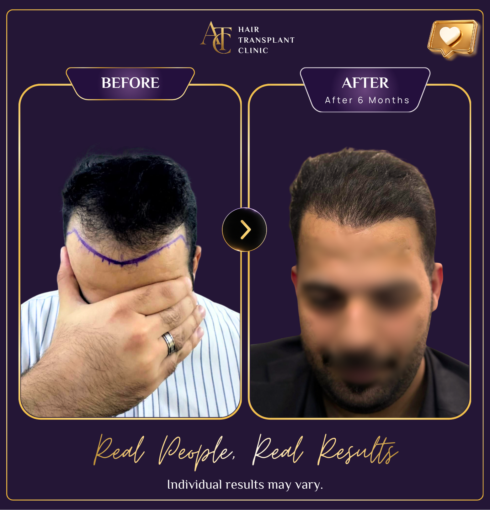 Hair transplant before and after result 33