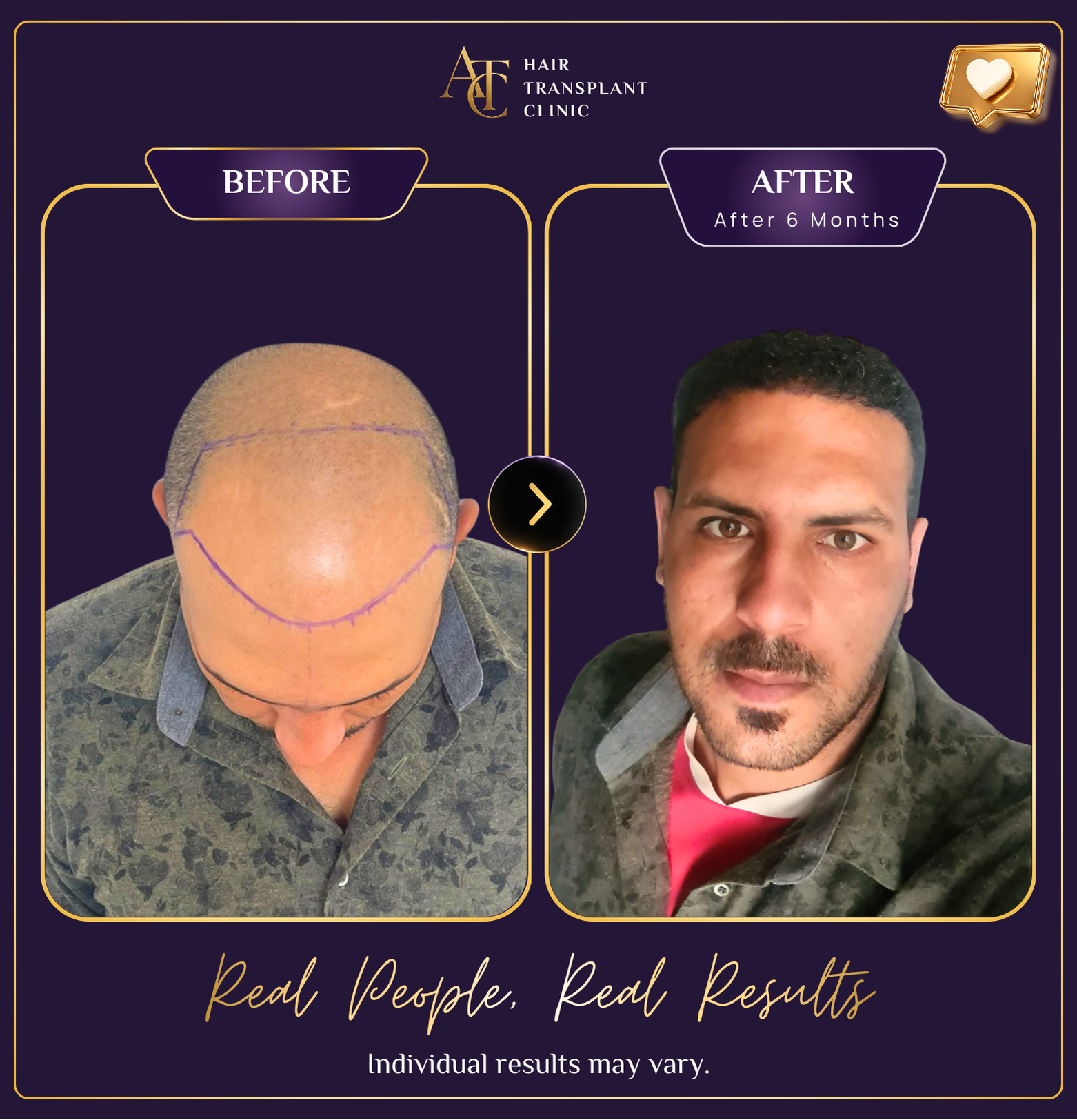 Hair transplant before and after result 34
