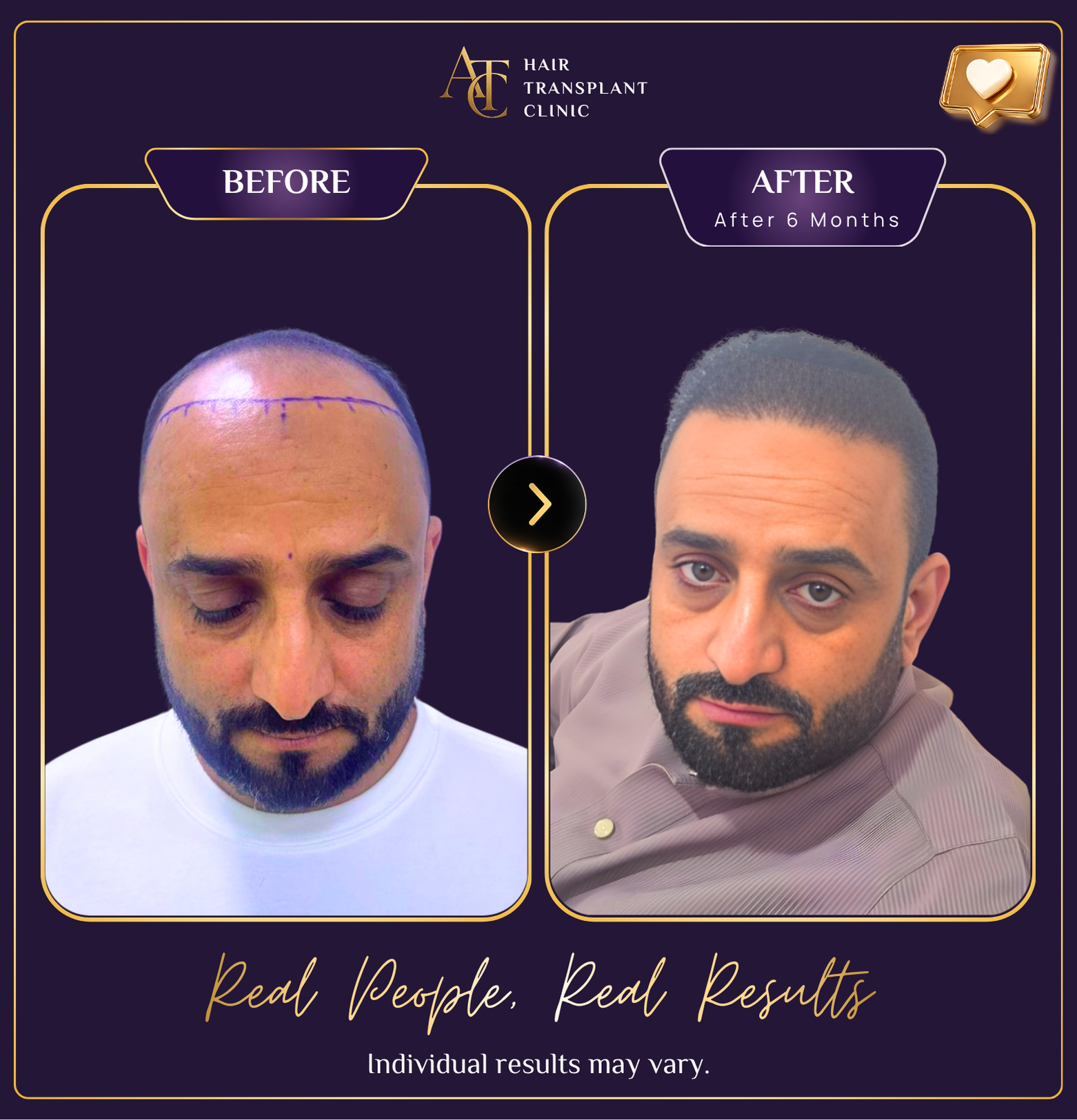 Hair transplant before and after result 35