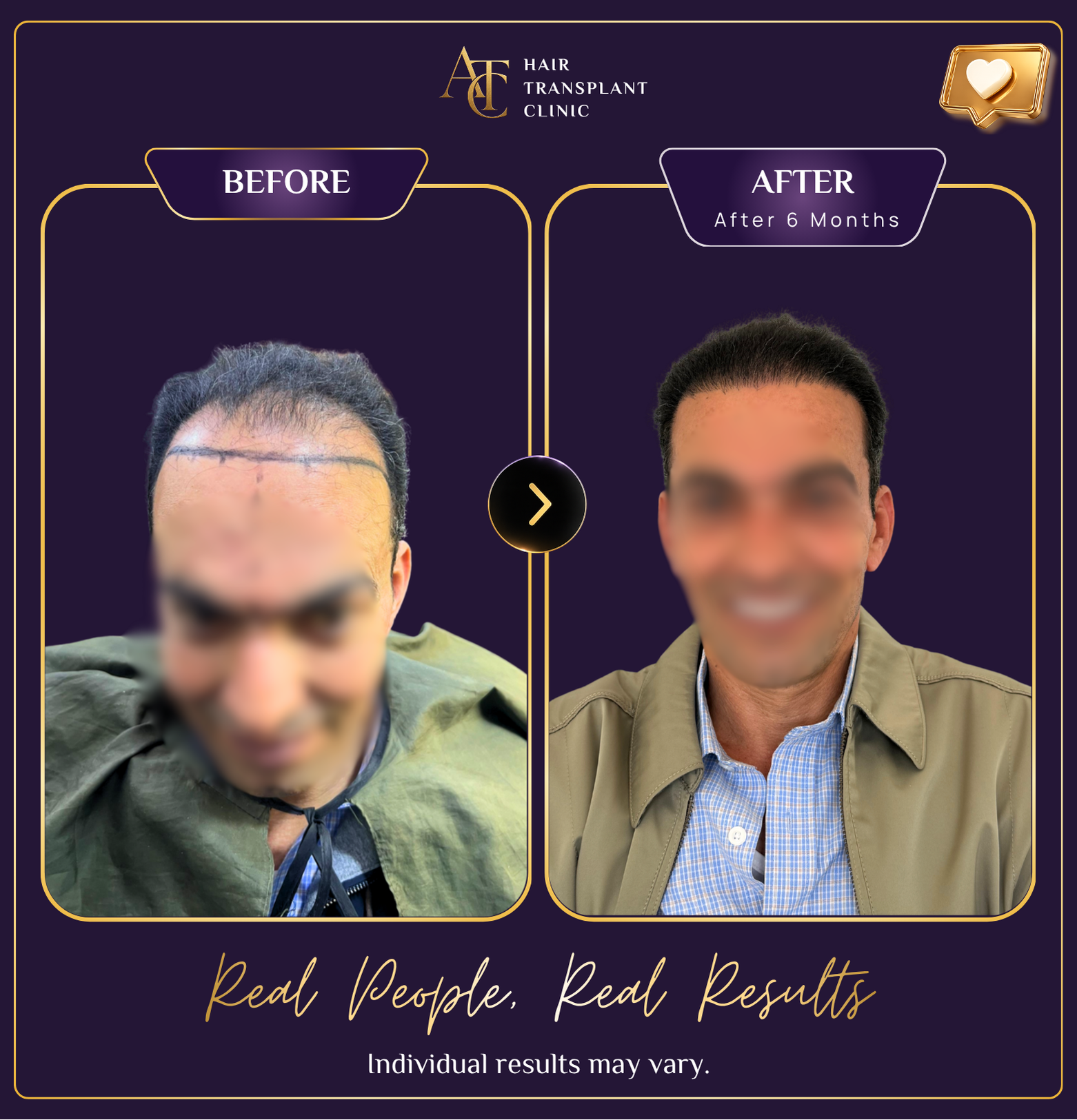 Hair transplant before and after result 36