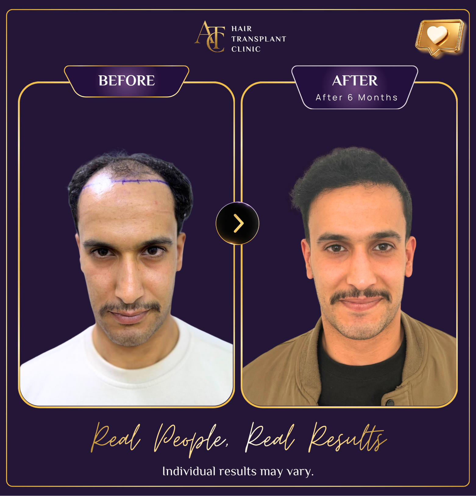 Hair transplant before and after result 37