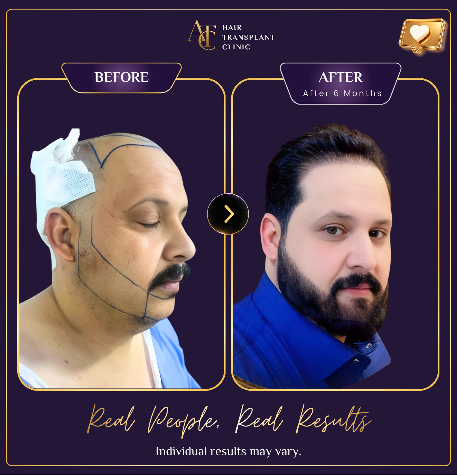 Hair transplant before and after result 38
