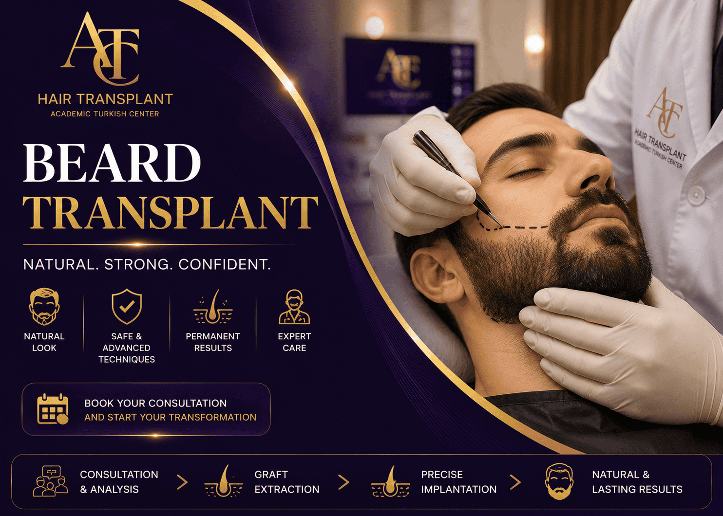 Beard Transplant Guide