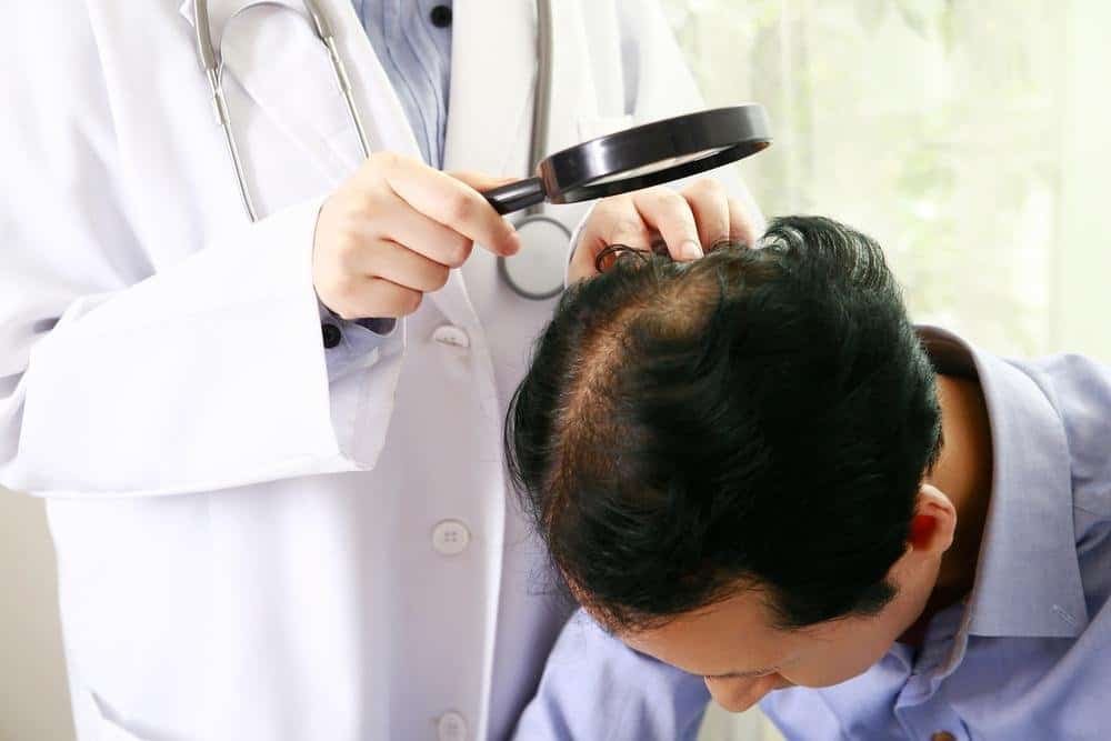 Stages of Hair Loss