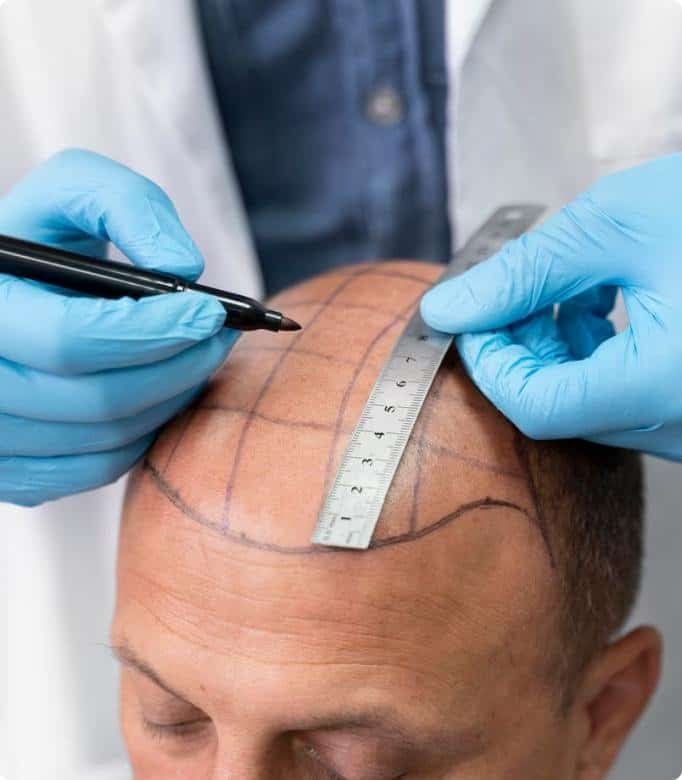 What Is a Hair Transplant?