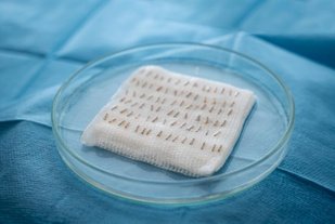 Extracted hair follicle grafts