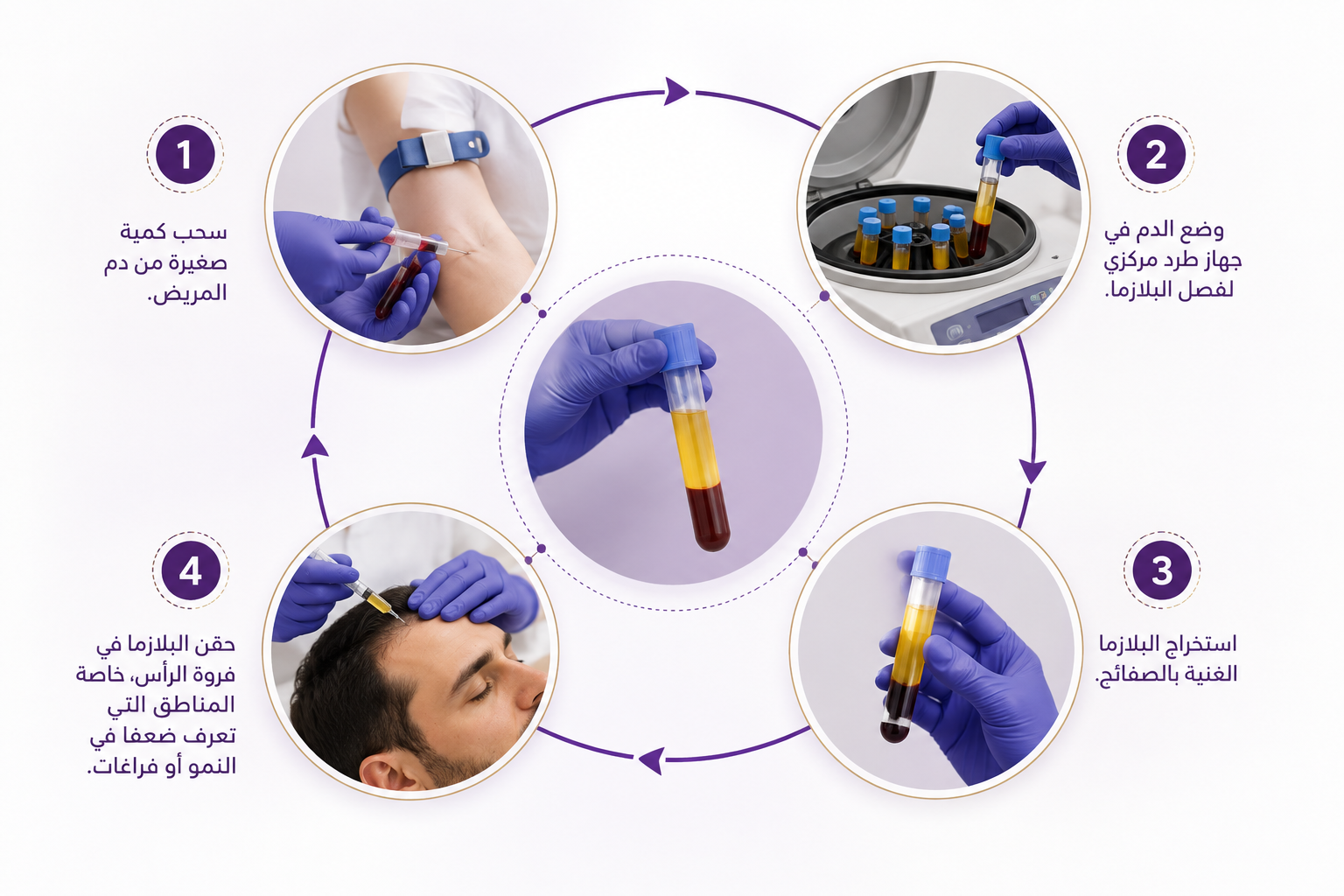 PRP treatment steps