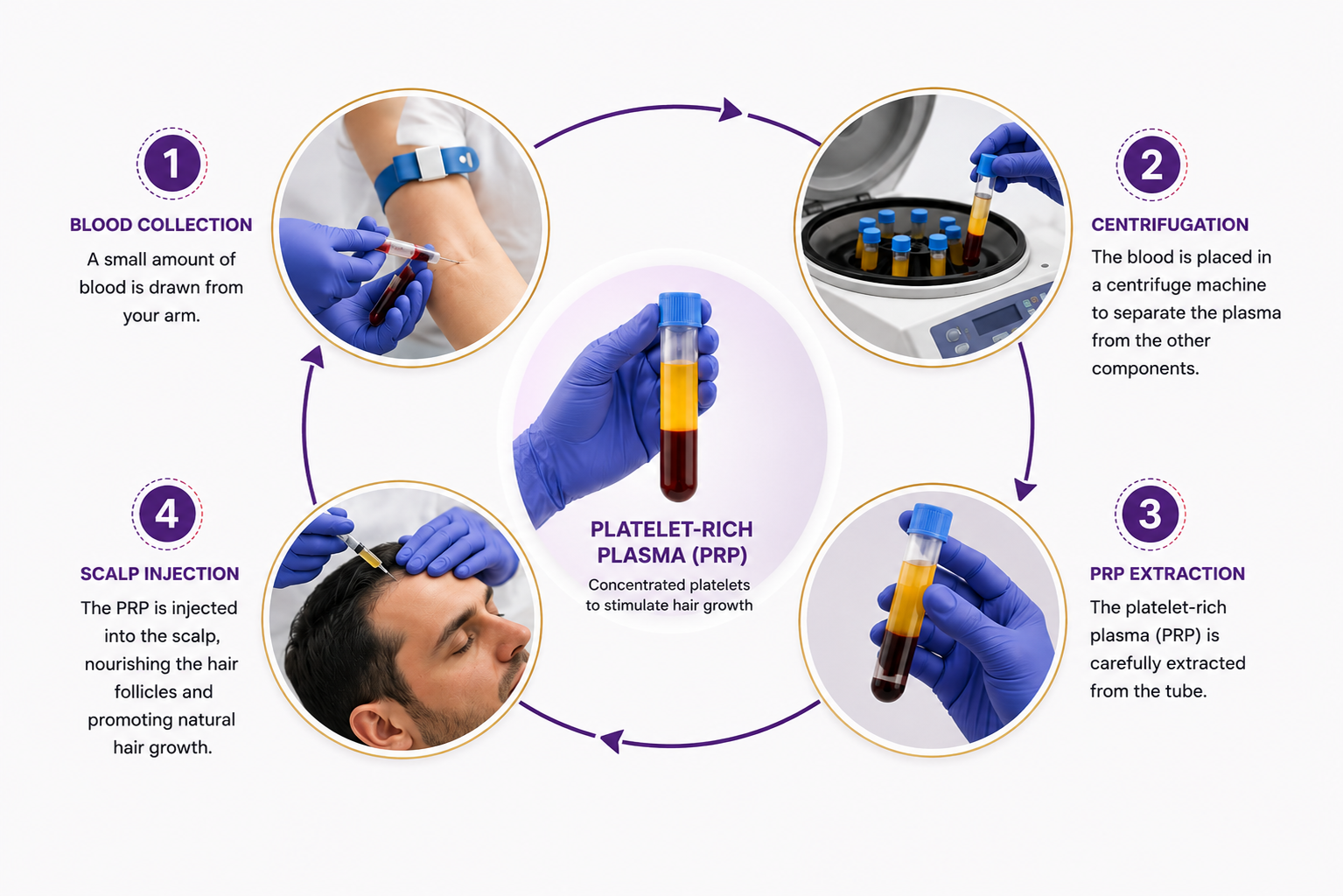 PRP treatment steps diagram